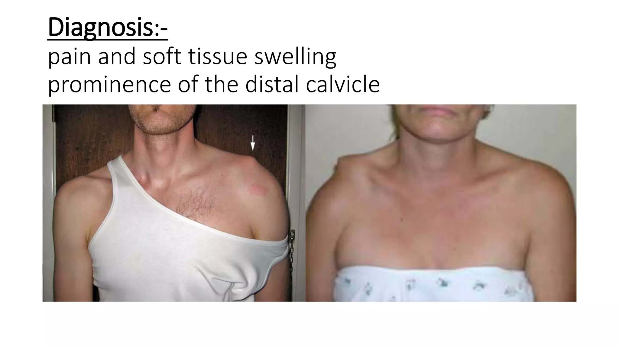 Diagnosis:-
pain and soft tissue swelling
prominence of the distal calvicle
 