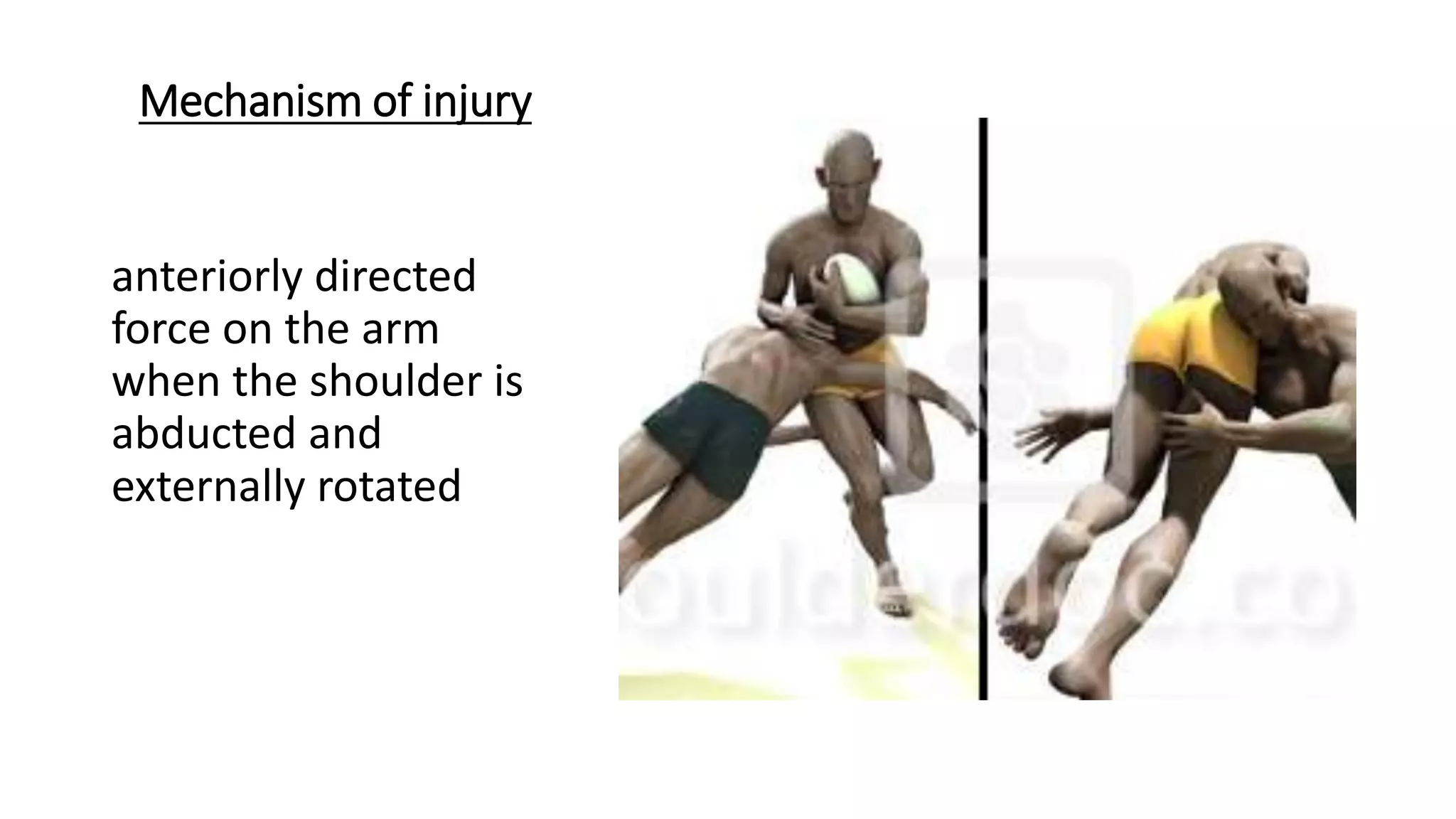 Mechanism of injury
anteriorly directed
force on the arm
when the shoulder is
abducted and
externally rotated
 
