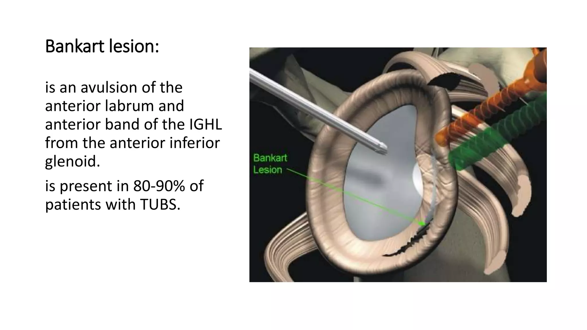 Bankart lesion:
is an avulsion of the
anterior labrum and
anterior band of the IGHL
from the anterior inferior
glenoid.
is present in 80-90% of
patients with TUBS.
 