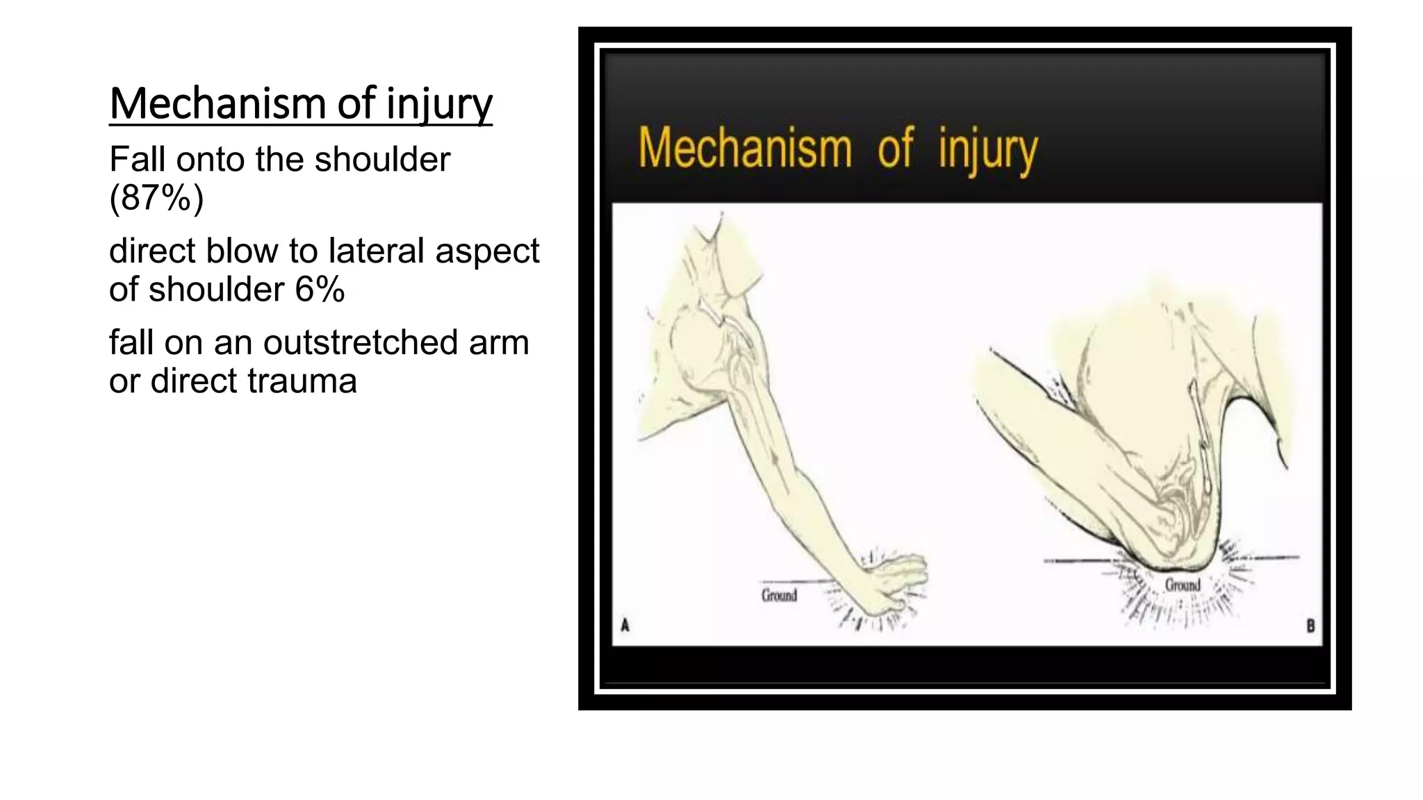 Mechanism of injury
Fall onto the shoulder
(87%)
direct blow to lateral aspect
of shoulder 6%
fall on an outstretched arm
or direct trauma
 