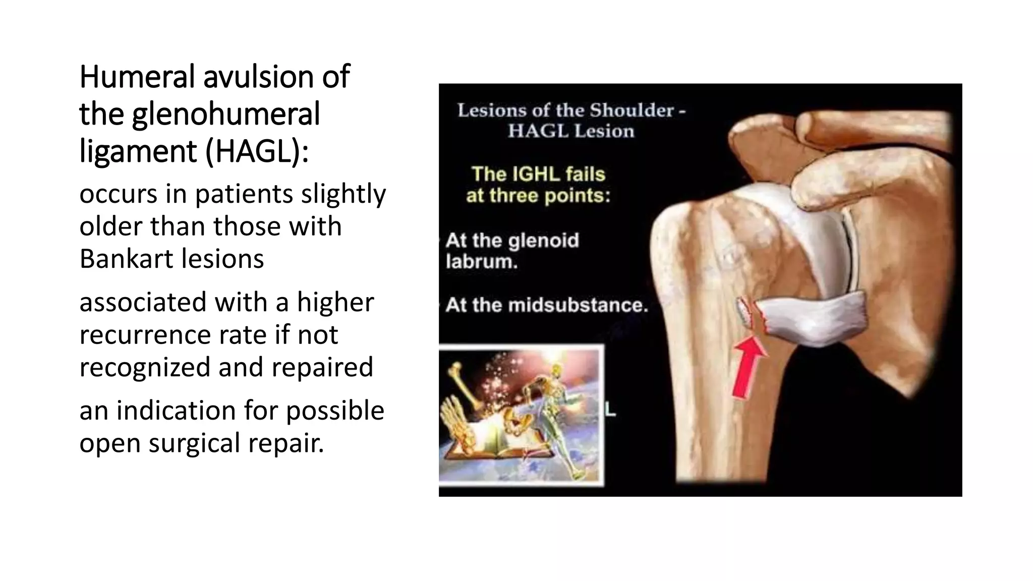 Humeral avulsion of
the glenohumeral
ligament (HAGL):
occurs in patients slightly
older than those with
Bankart lesions
associated with a higher
recurrence rate if not
recognized and repaired
an indication for possible
open surgical repair.
 