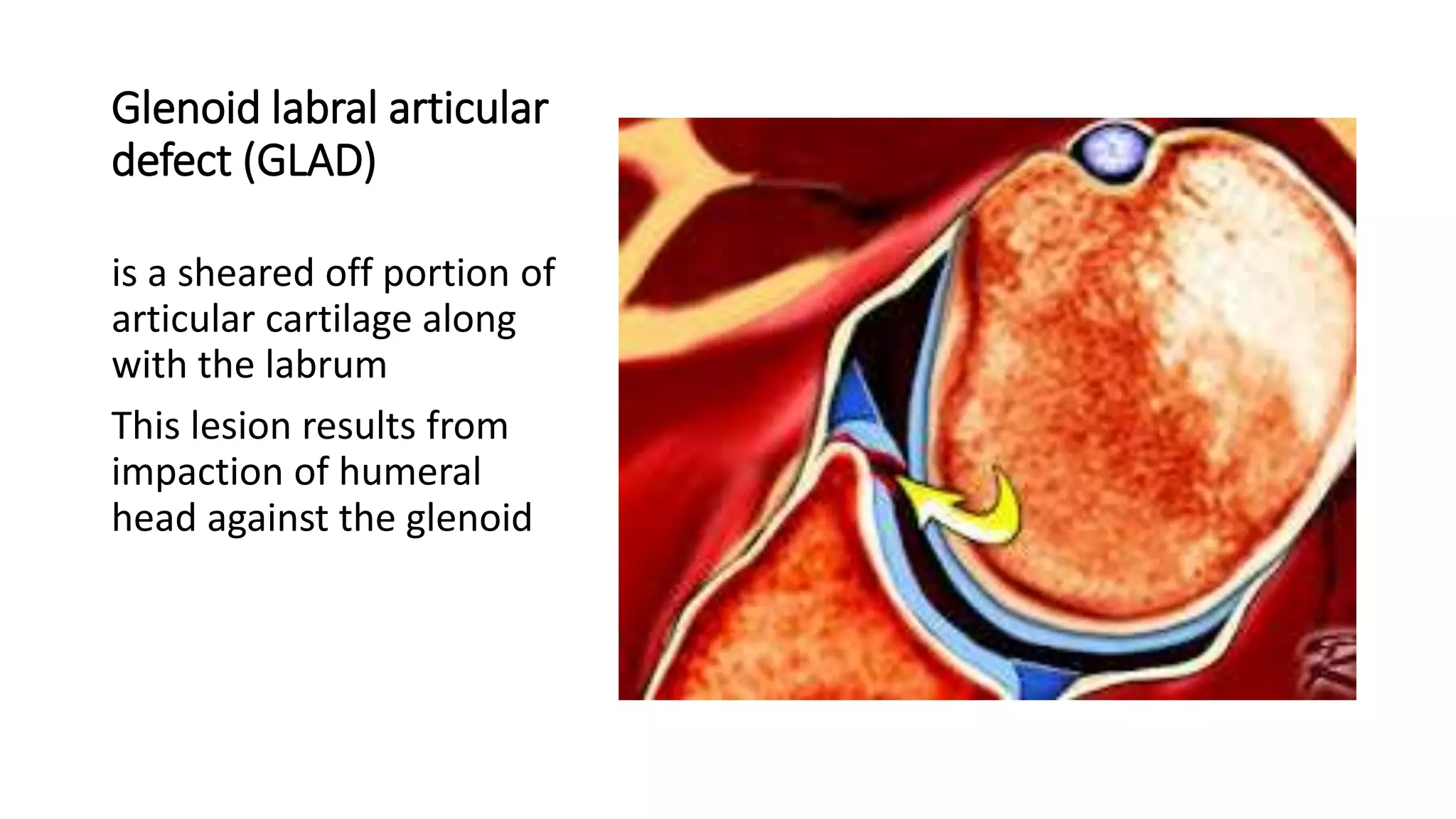 Glenoid labral articular
defect (GLAD)
is a sheared off portion of
articular cartilage along
with the labrum
This lesion results from
impaction of humeral
head against the glenoid
 
