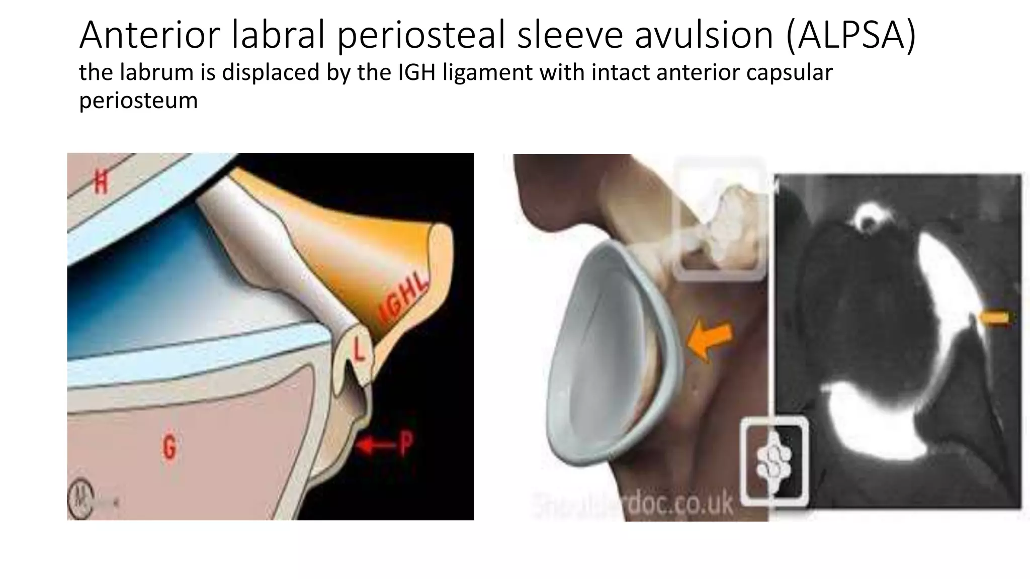 Anterior labral periosteal sleeve avulsion (ALPSA)
the labrum is displaced by the IGH ligament with intact anterior capsular
periosteum
 