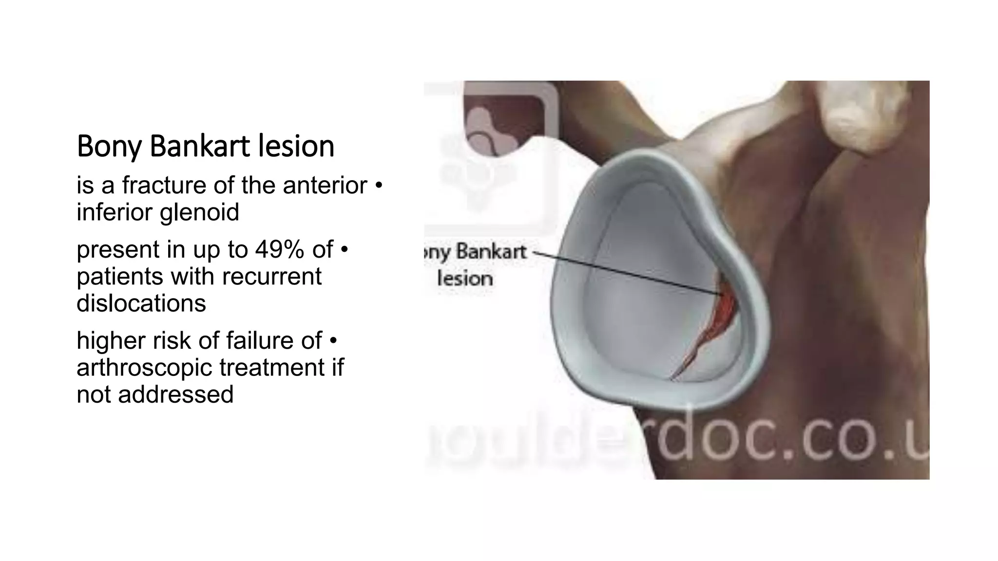 Bony Bankart lesion
•is a fracture of the anterior
inferior glenoid
•present in up to 49% of
patients with recurrent
dislocations
•higher risk of failure of
arthroscopic treatment if
not addressed
 