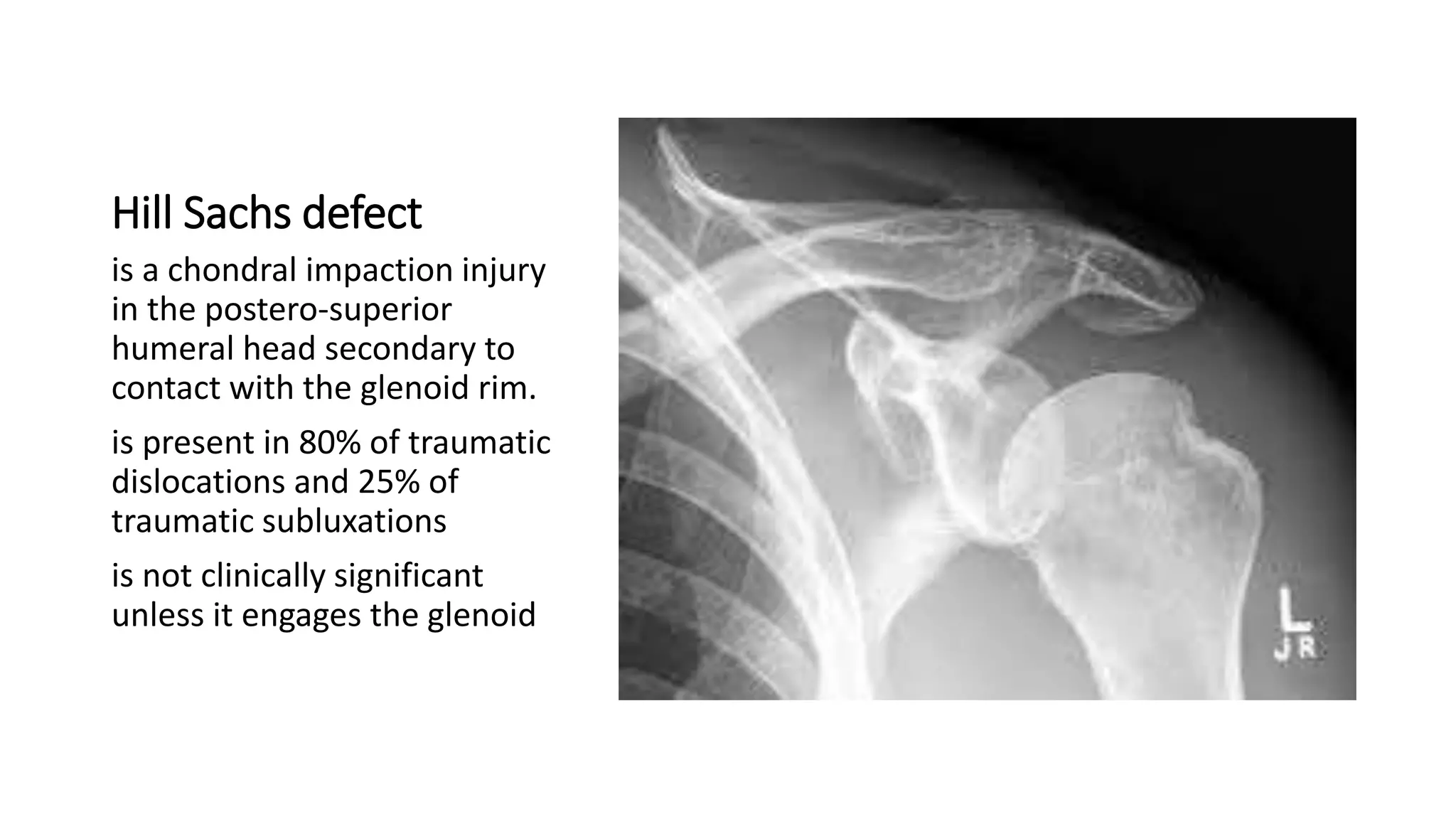 Hill Sachs defect
is a chondral impaction injury
in the postero-superior
humeral head secondary to
contact with the glenoid rim.
is present in 80% of traumatic
dislocations and 25% of
traumatic subluxations
is not clinically significant
unless it engages the glenoid
 