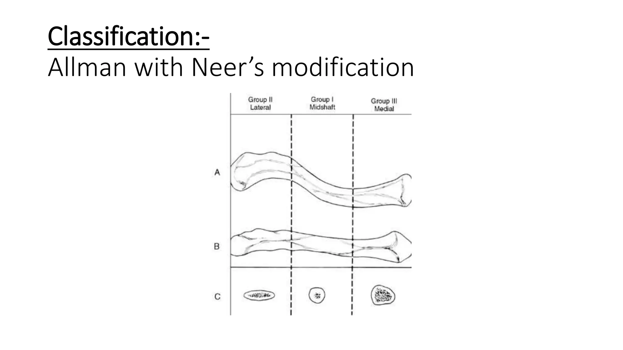 Classification:-
Allman with Neer’s modification
 