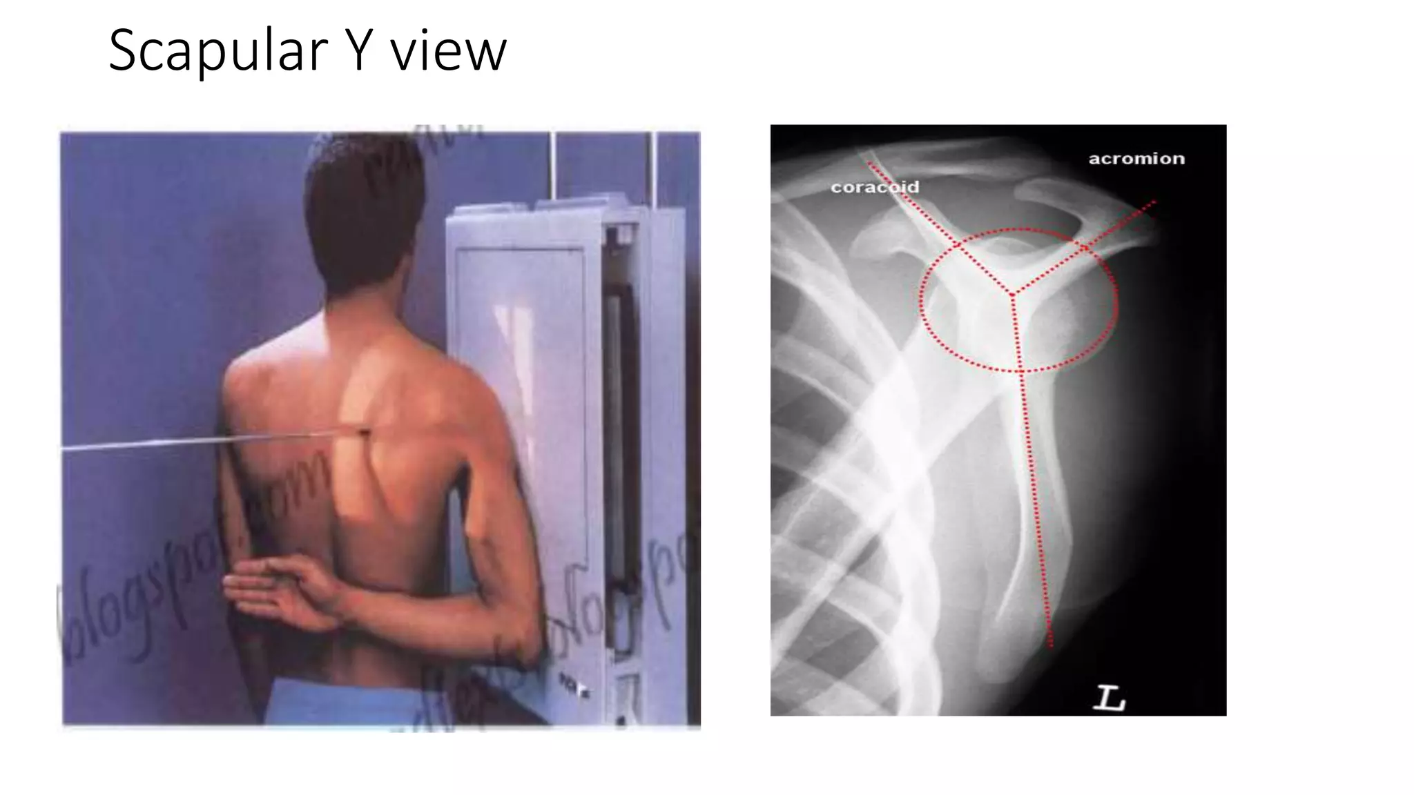 Scapular Y view
 