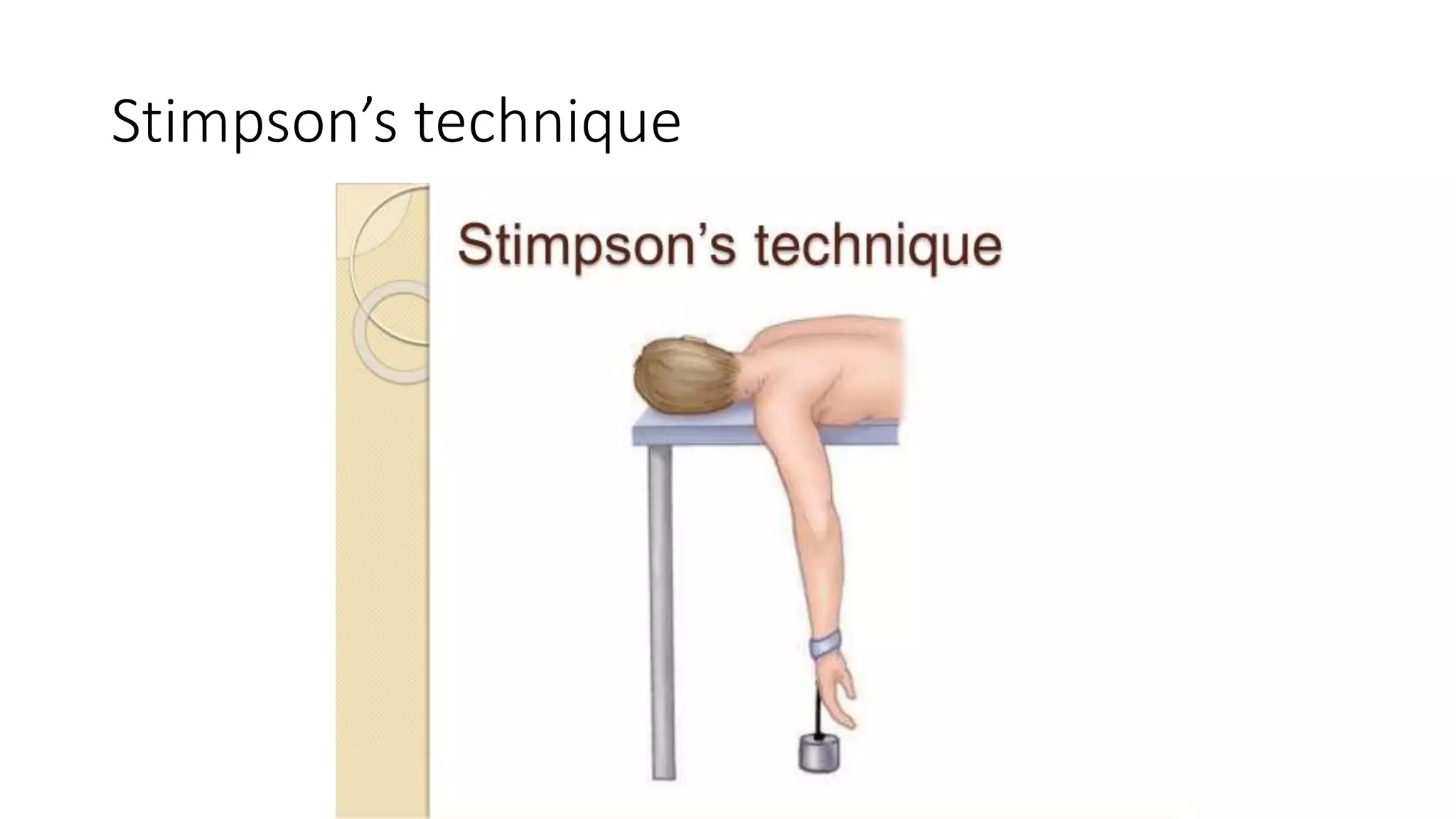 Stimpson’s technique
 