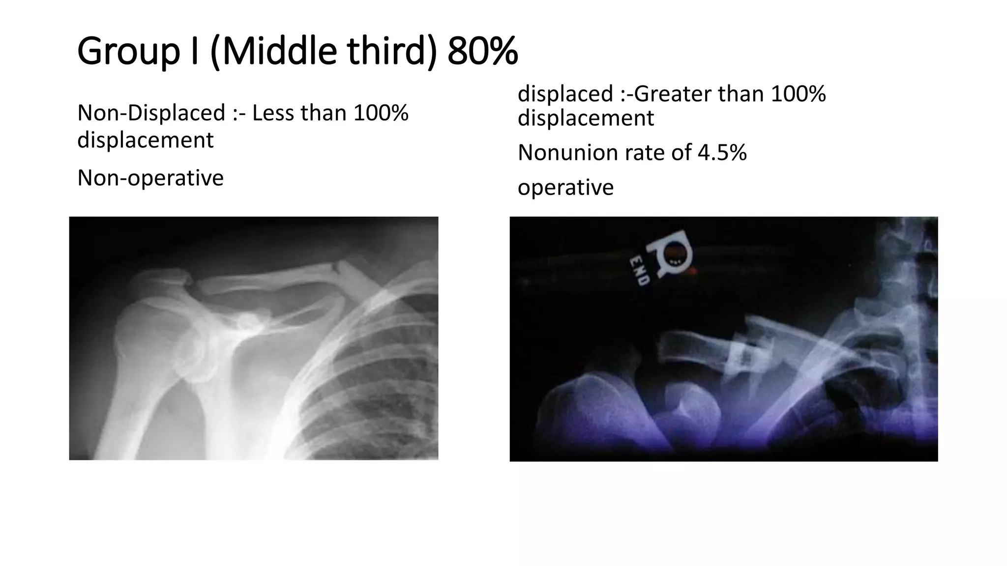 Group I (Middle third) 80%
Non-Displaced :- Less than 100%
displacement
Non-operative
displaced :-Greater than 100%
displacement
Nonunion rate of 4.5%
operative
 