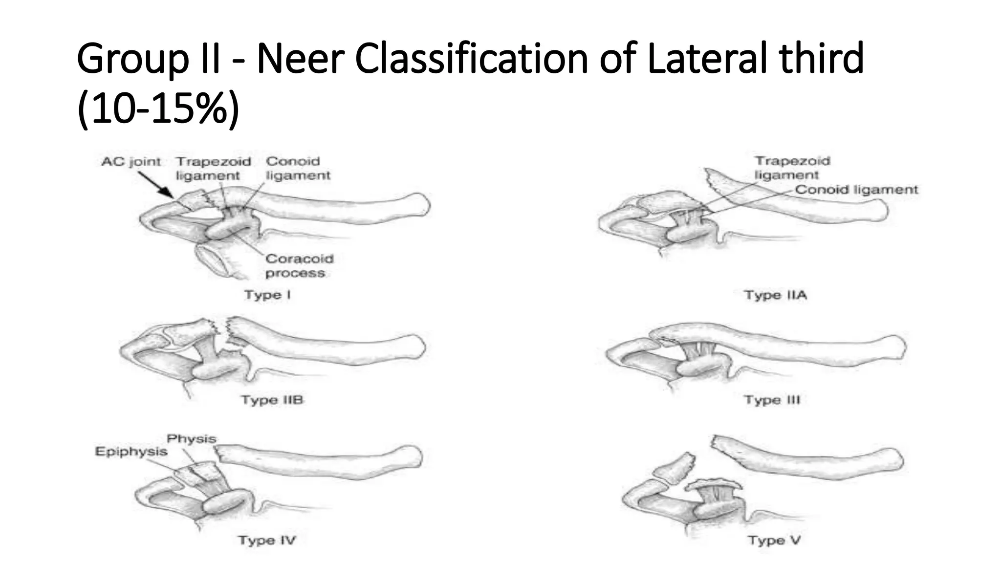 Group II - Neer Classification of Lateral third
(10-15%)
 