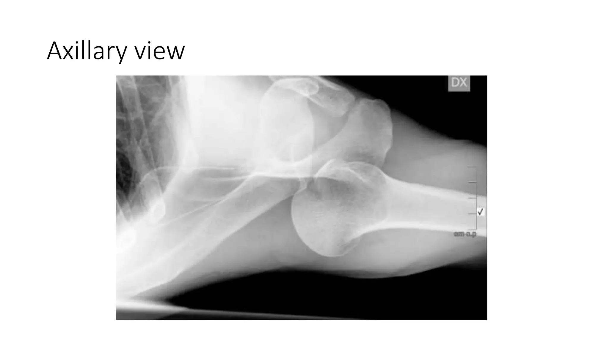 Axillary view
 