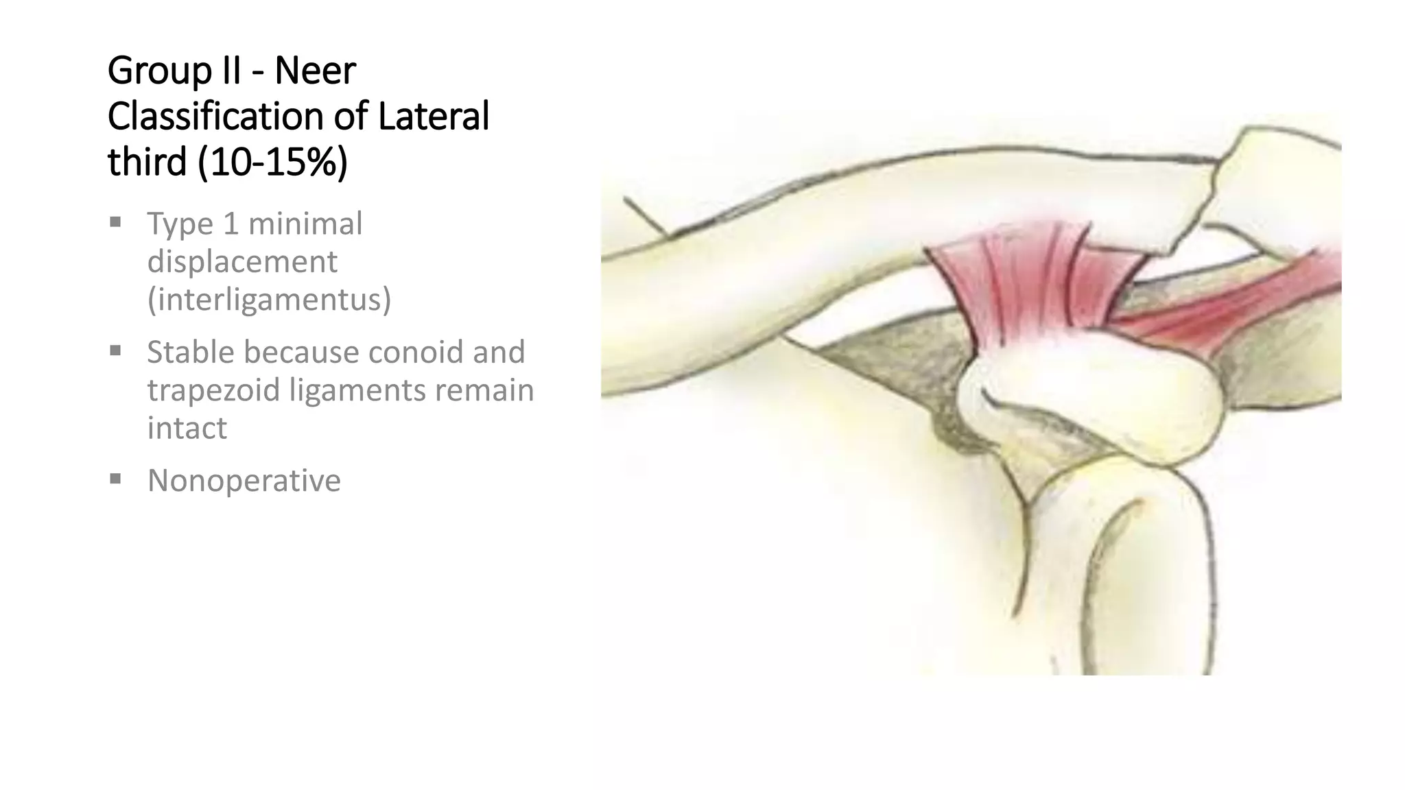 Group II - Neer
Classification of Lateral
third (10-15%)
 Type 1 minimal
displacement
(interligamentus)
 Stable because conoid and
trapezoid ligaments remain
intact
 Nonoperative
 