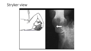 Fracture and dislocation of the shoulder girdle | PPTX
