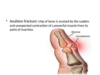 FRACTURE AND ITS CLASSIFICATIONS.slideshare | PPTX