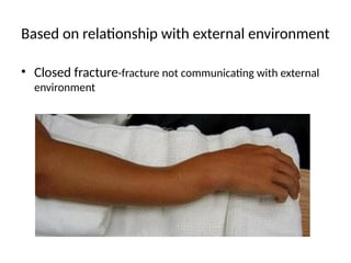 FRACTURE AND ITS CLASSIFICATIONS.slideshare | PPTX