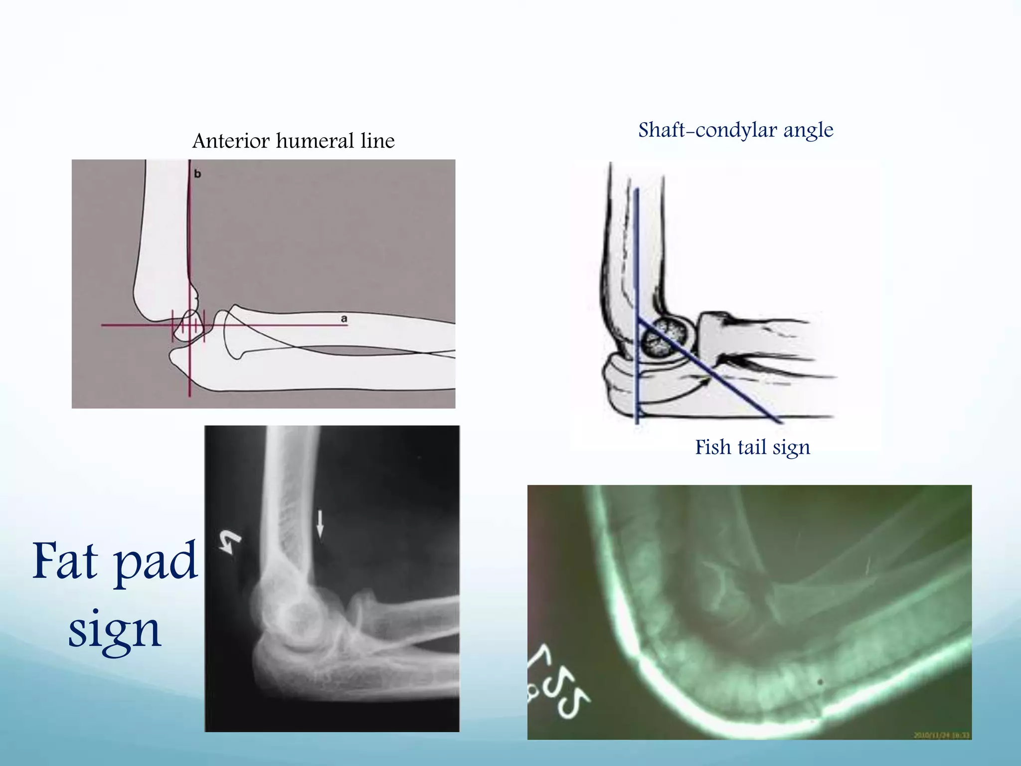 Anterior humeral line Shaft-condylar angle
Fat pad
sign
Fish tail sign
 