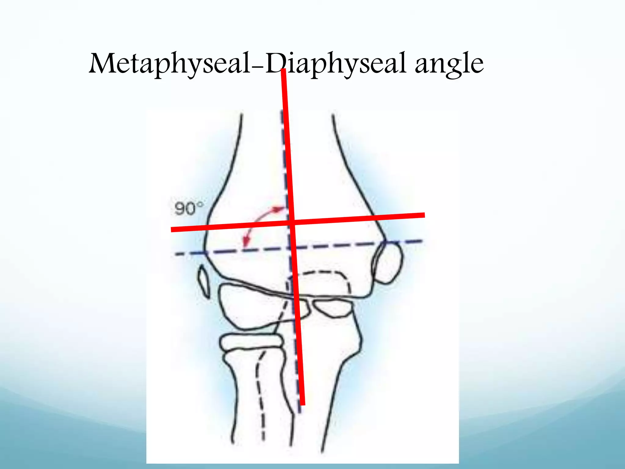 Metaphyseal-Diaphyseal angle
 