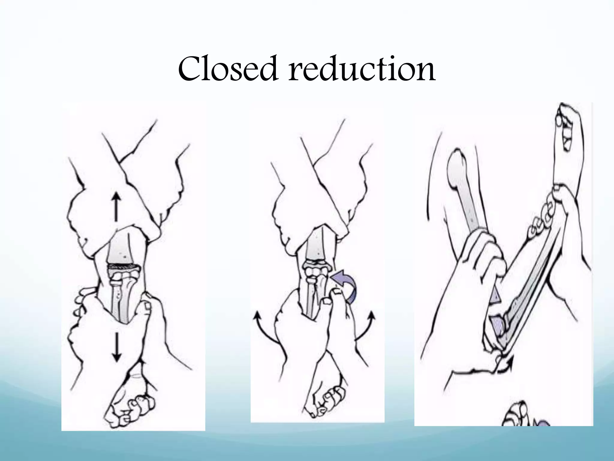 Closed reduction
 