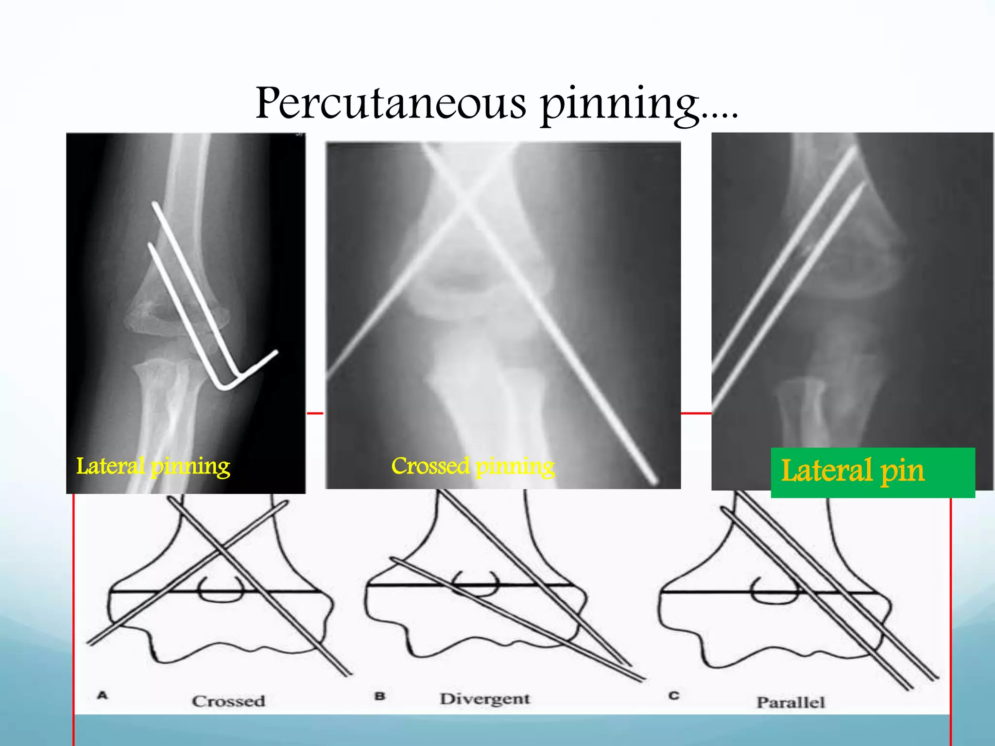 Percutaneous pinning....
Lateral pinning Crossed pinning Lateral pin
 