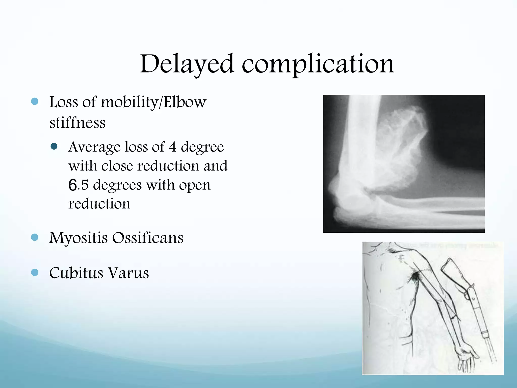 Delayed complication
 Loss of mobility/Elbow
stiffness
 Average loss of 4 degree
with close reduction and
6.5 degrees with open
reduction
 Myositis Ossificans
 Cubitus Varus
 