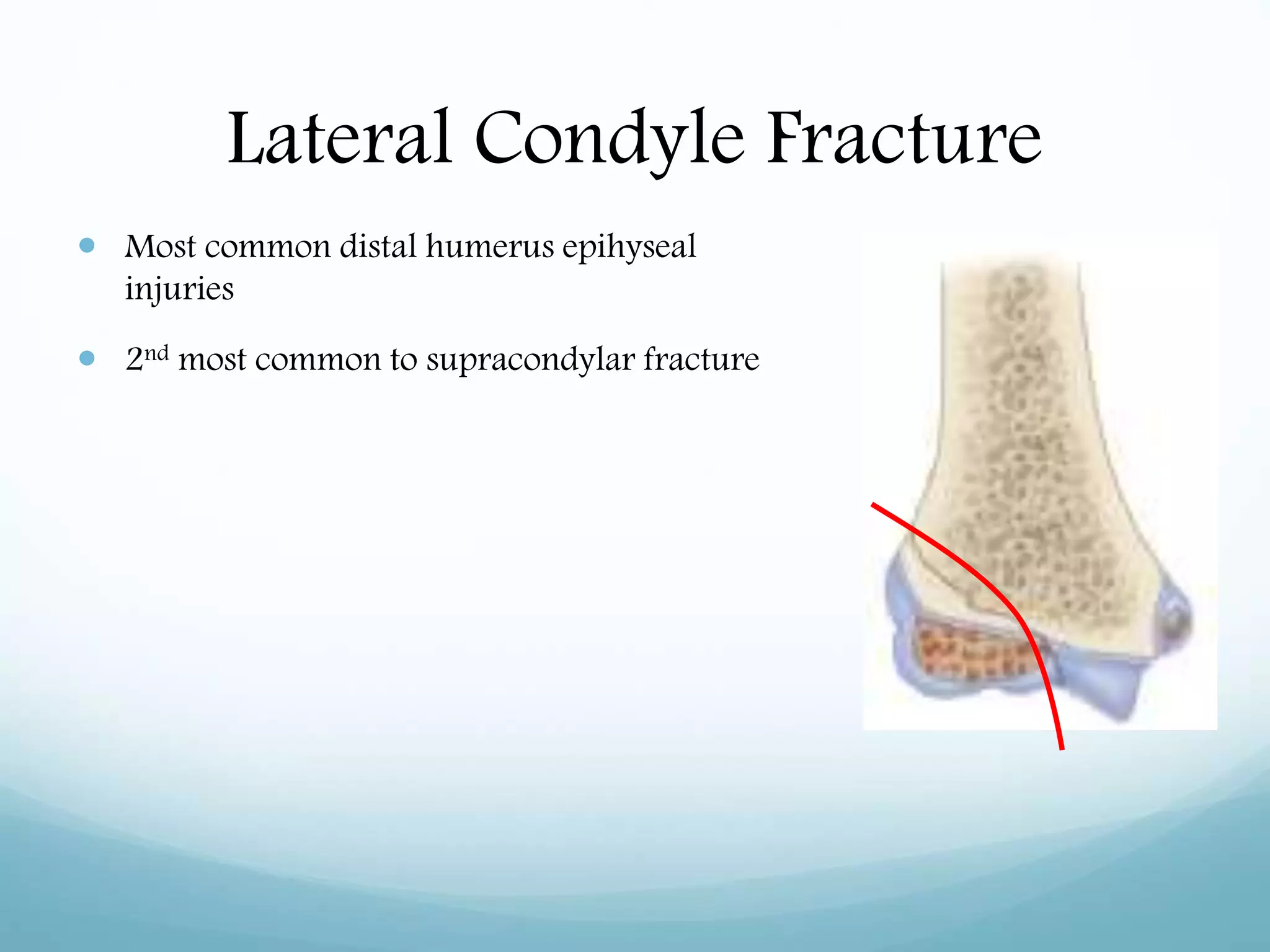 Lateral Condyle Fracture
 Most common distal humerus epihyseal
injuries
 2nd most common to supracondylar fracture
 