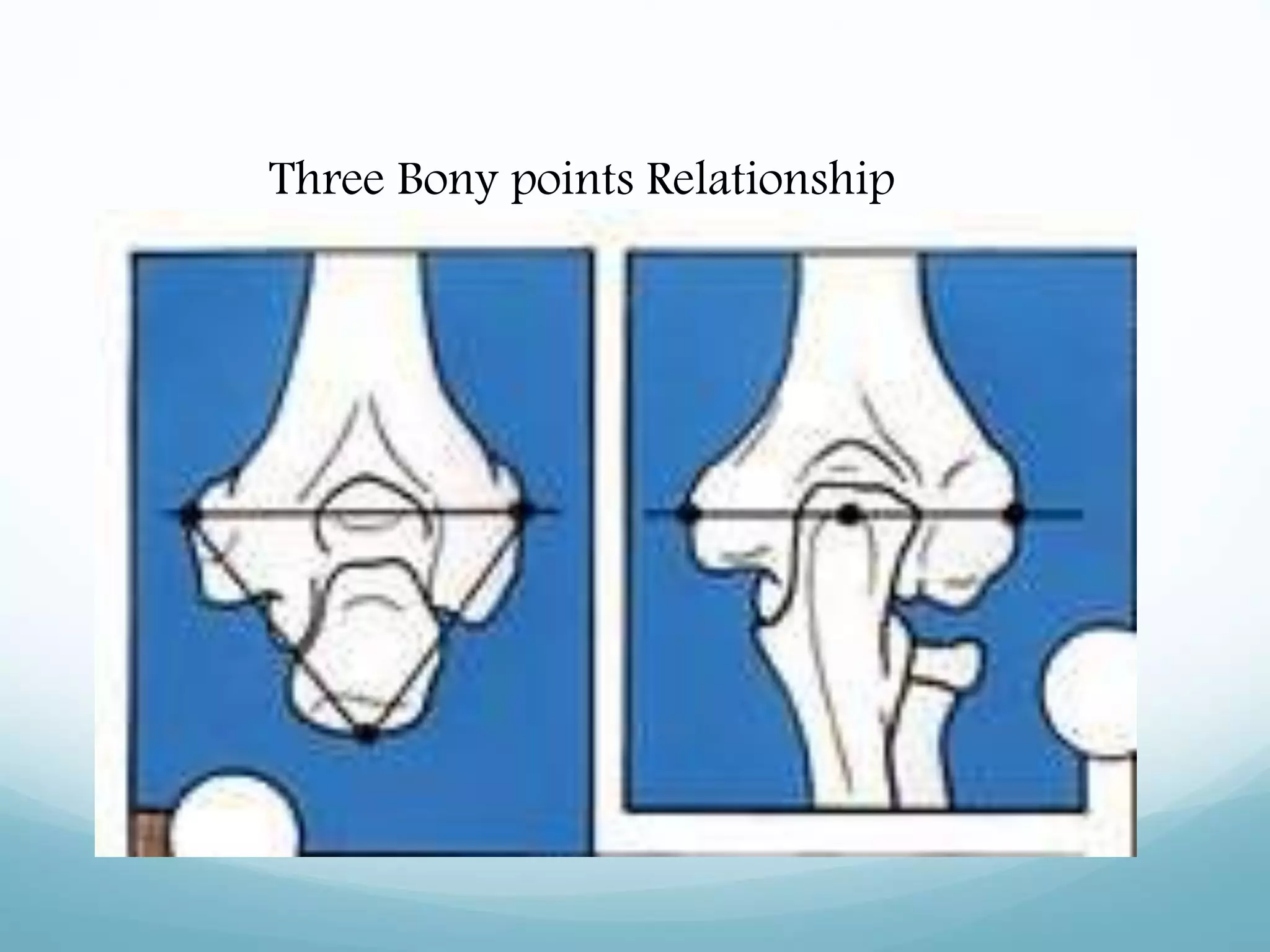Three Bony points Relationship
 