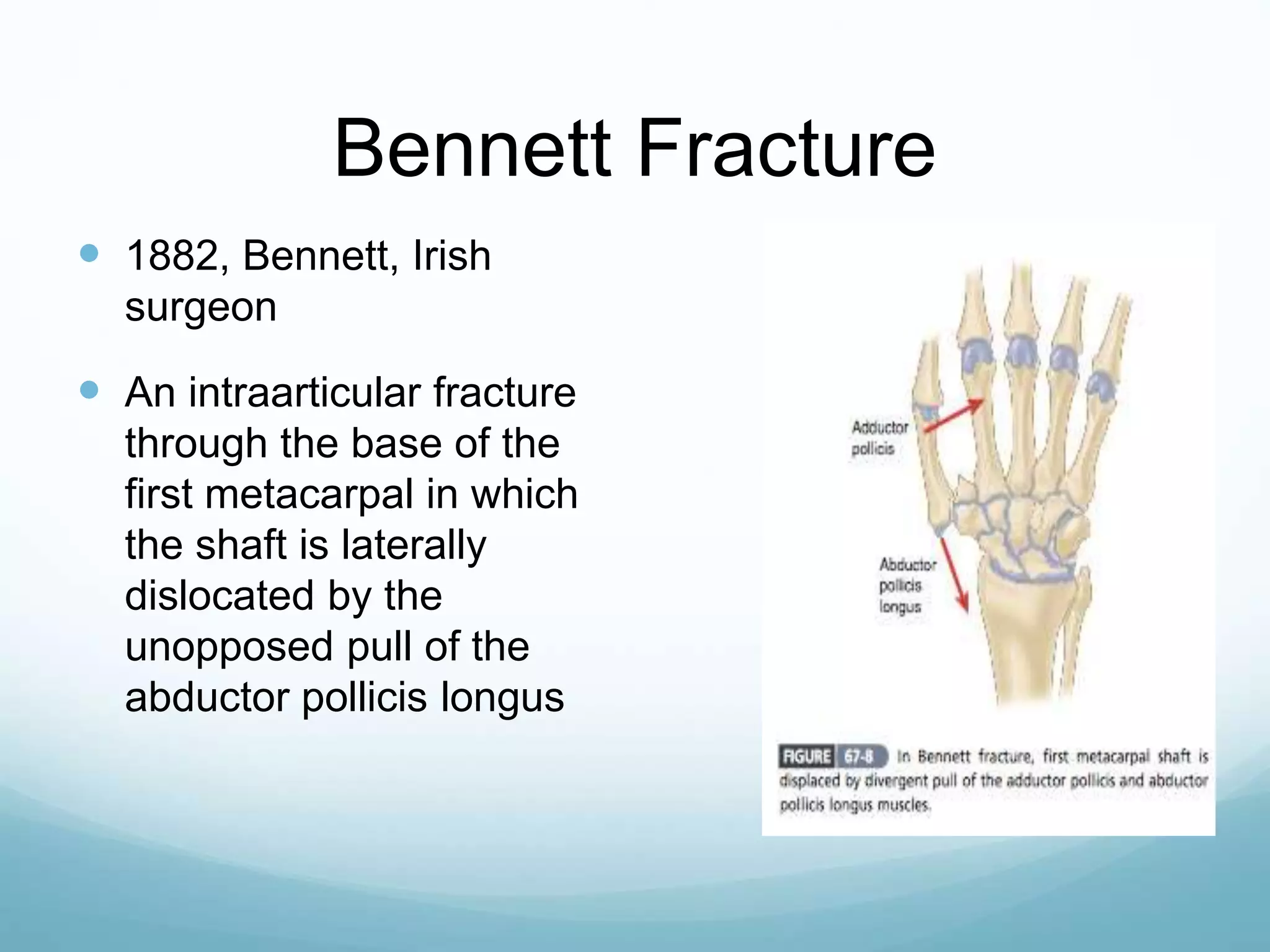 Bennett Fracture
 1882, Bennett, Irish
surgeon
 An intraarticular fracture
through the base of the
first metacarpal in which
the shaft is laterally
dislocated by the
unopposed pull of the
abductor pollicis longus
 
