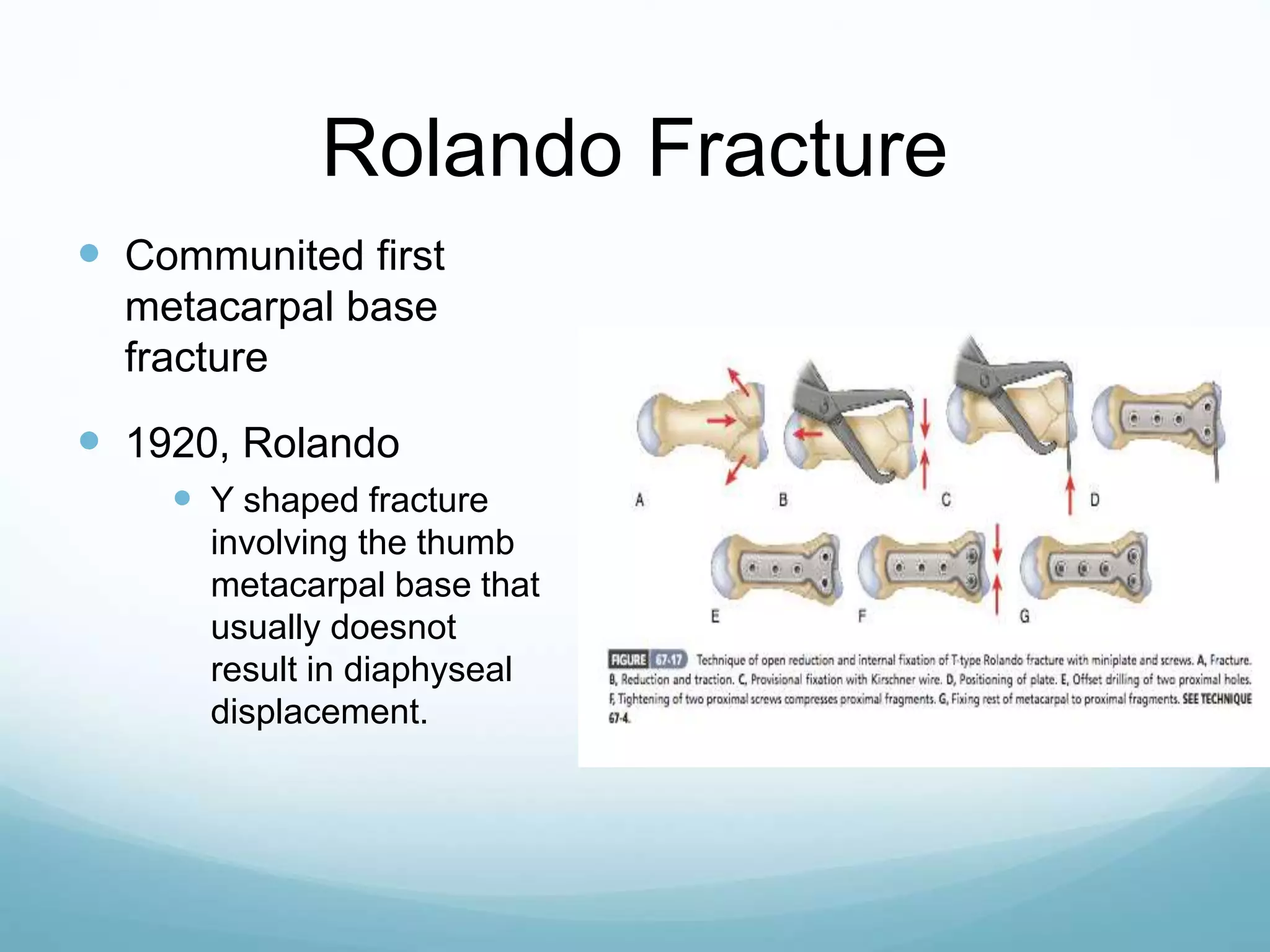 Rolando Fracture
 Communited first
metacarpal base
fracture
 1920, Rolando
 Y shaped fracture
involving the thumb
metacarpal base that
usually doesnot
result in diaphyseal
displacement.
 
