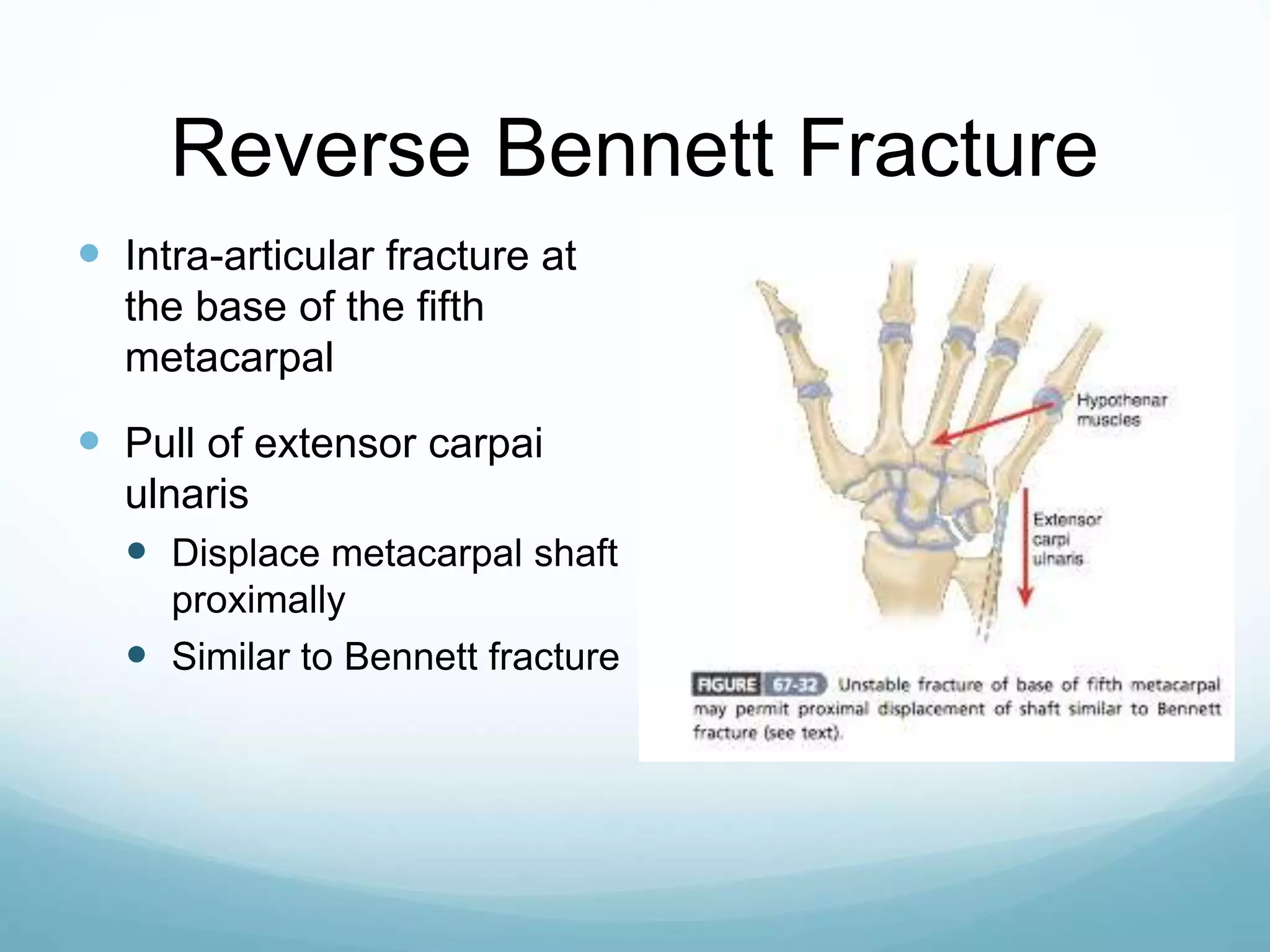 Reverse Bennett Fracture
 Intra-articular fracture at
the base of the fifth
metacarpal
 Pull of extensor carpai
ulnaris
 Displace metacarpal shaft
proximally
 Similar to Bennett fracture
 