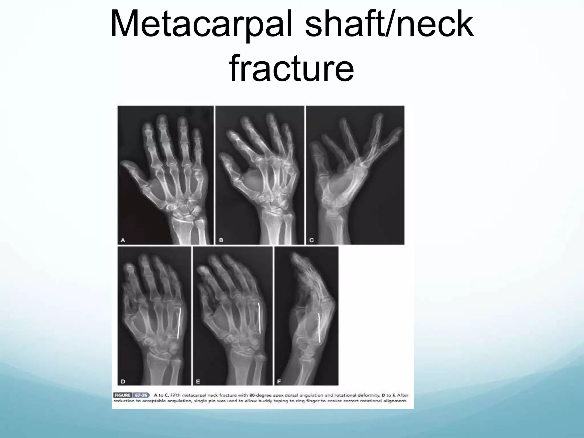 Metacarpal shaft/neck
fracture
 