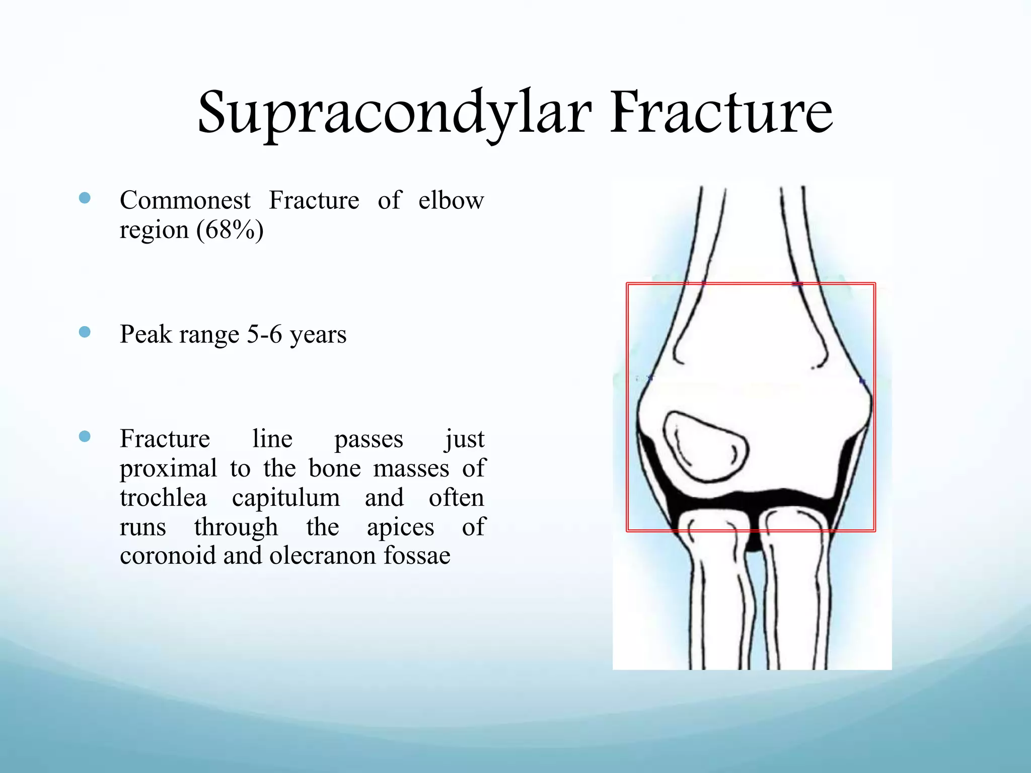 Supracondylar Fracture
 Commonest Fracture of elbow
region (68%)
 Peak range 5-6 years
 Fracture line passes just
proximal to the bone masses of
trochlea capitulum and often
runs through the apices of
coronoid and olecranon fossae
 