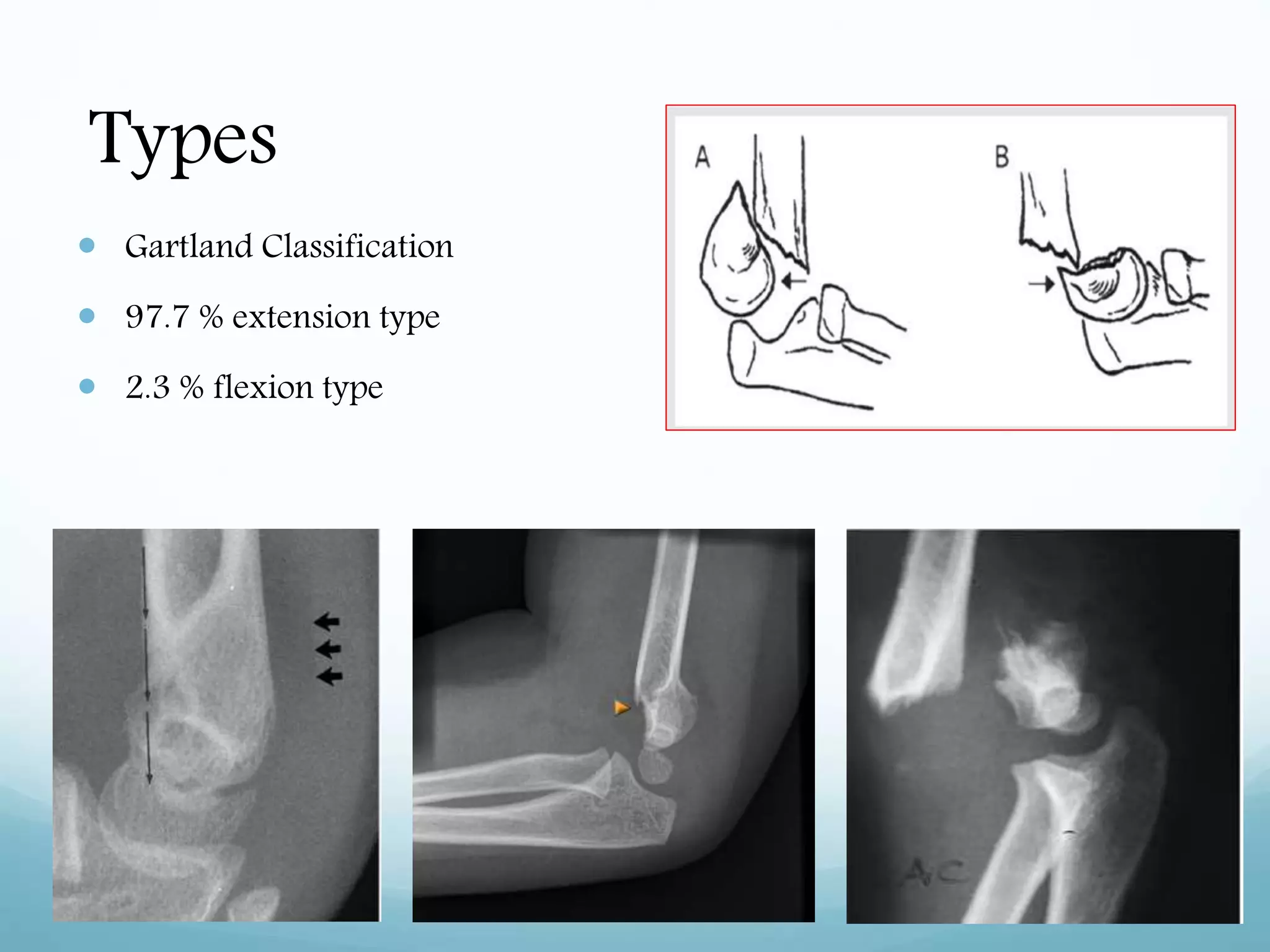 Types
 Gartland Classification
 97.7 % extension type
 2.3 % flexion type
 
