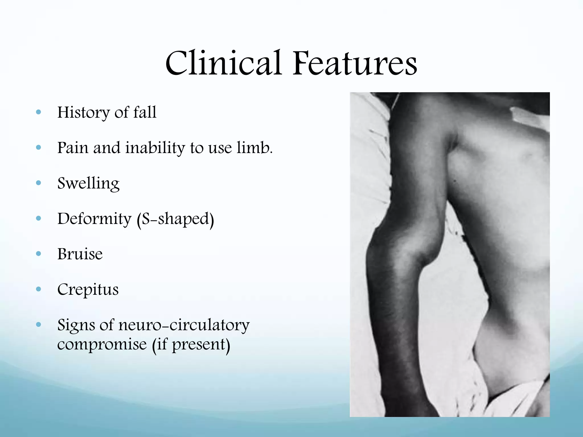 Clinical Features
• History of fall
• Pain and inability to use limb.
• Swelling
• Deformity (S-shaped)
• Bruise
• Crepitus
• Signs of neuro-circulatory
compromise (if present)
 