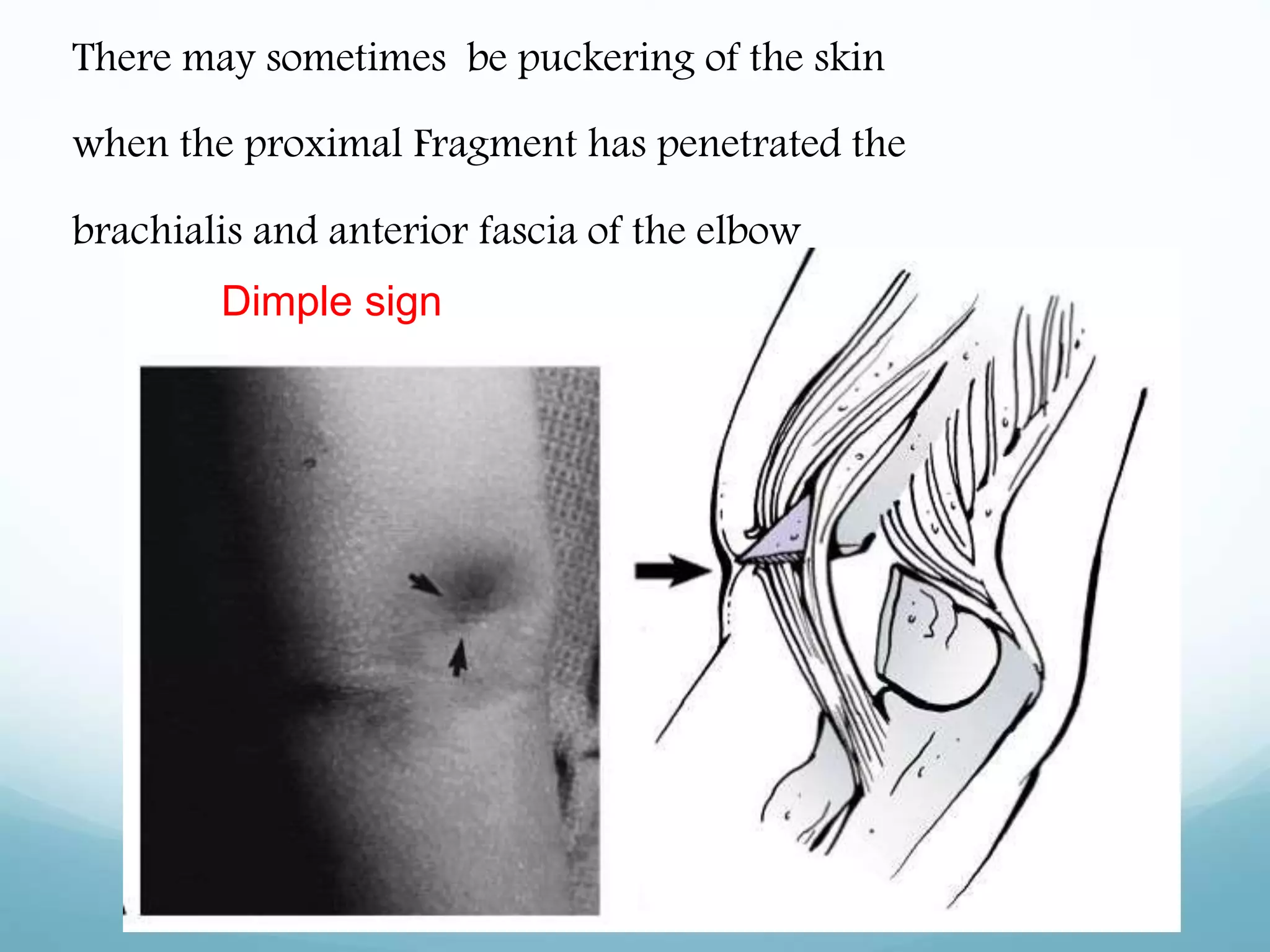 There may sometimes be puckering of the skin
when the proximal Fragment has penetrated the
brachialis and anterior fascia of the elbow
Dimple sign
 