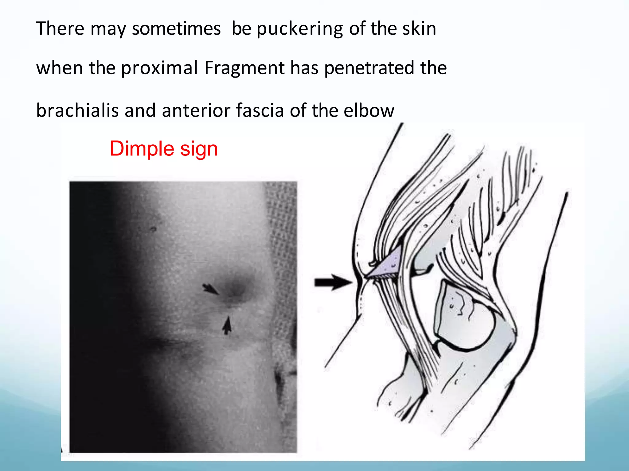 Fracture around elbow.pptx