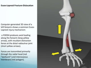 Fracture around elbow.pptx