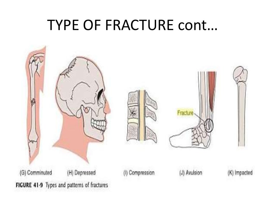 Fracture bed
