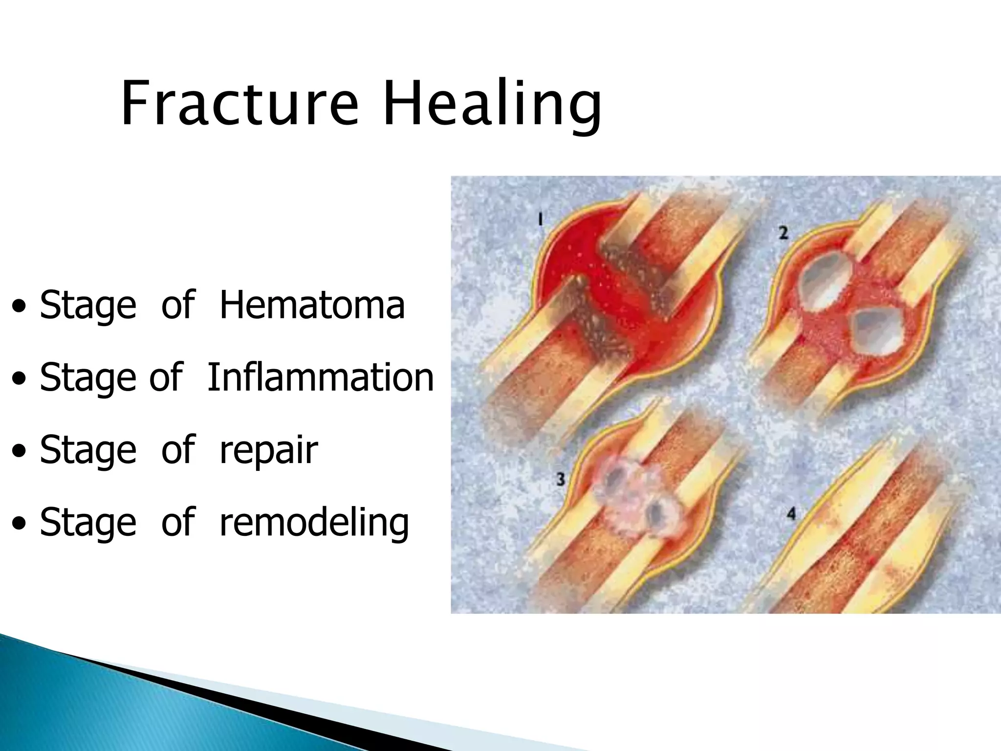 Fracture Healing
• Stage of Hematoma
• Stage of Inflammation

• Stage of repair
• Stage of remodeling

 
