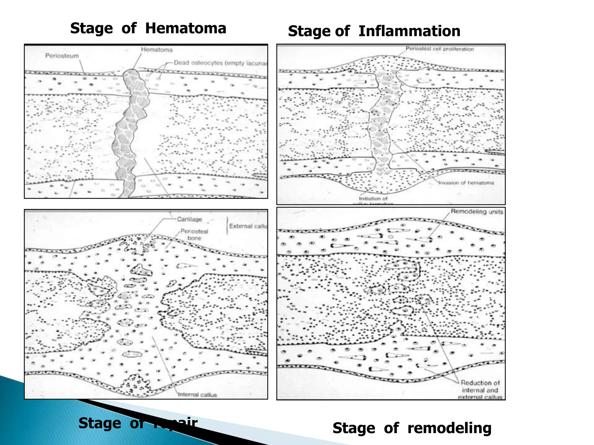 Stage of Hematoma

Stage of repair

Stage of Inflammation

Stage of remodeling

 