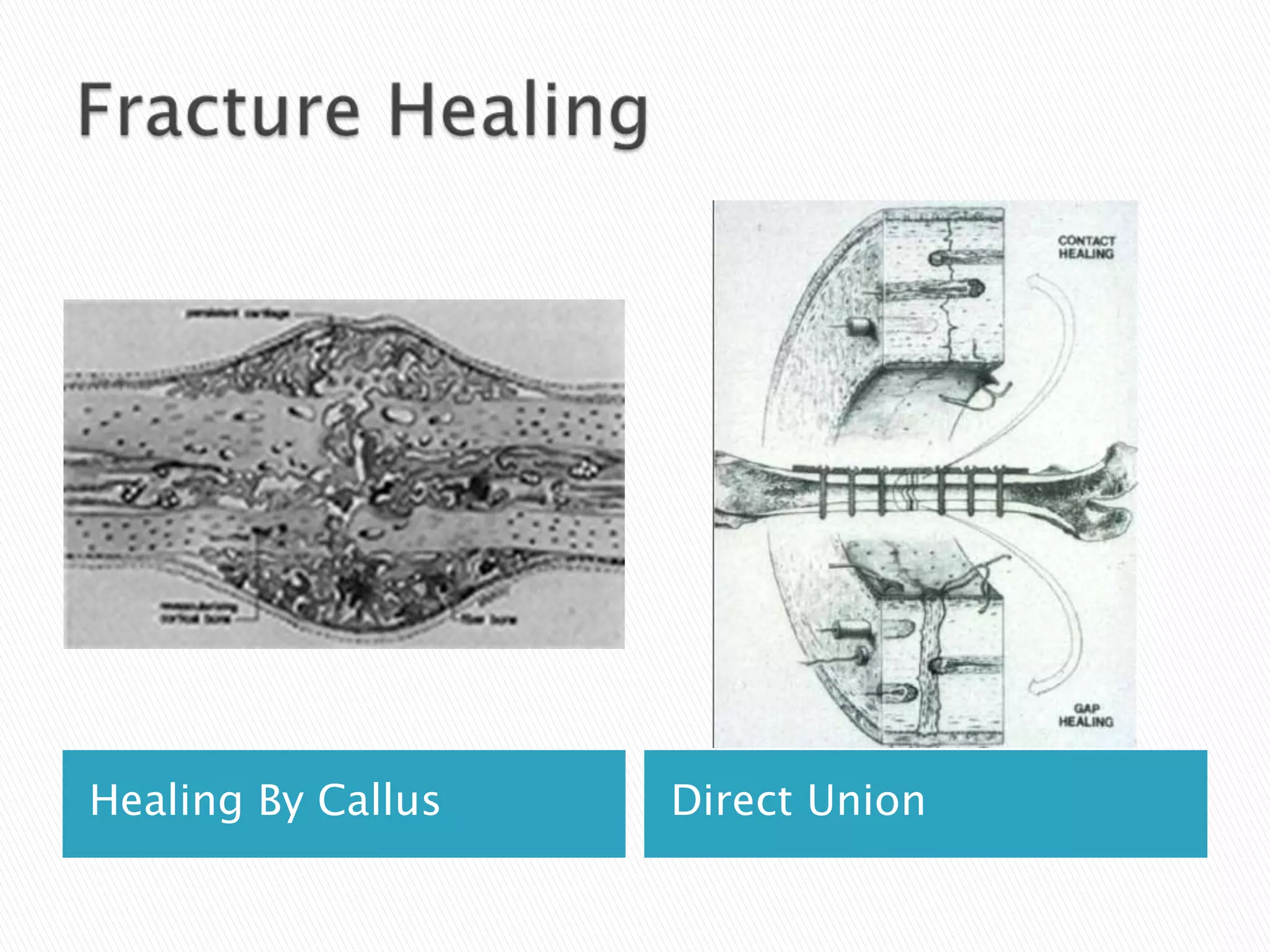 Healing By Callus

Direct Union

 