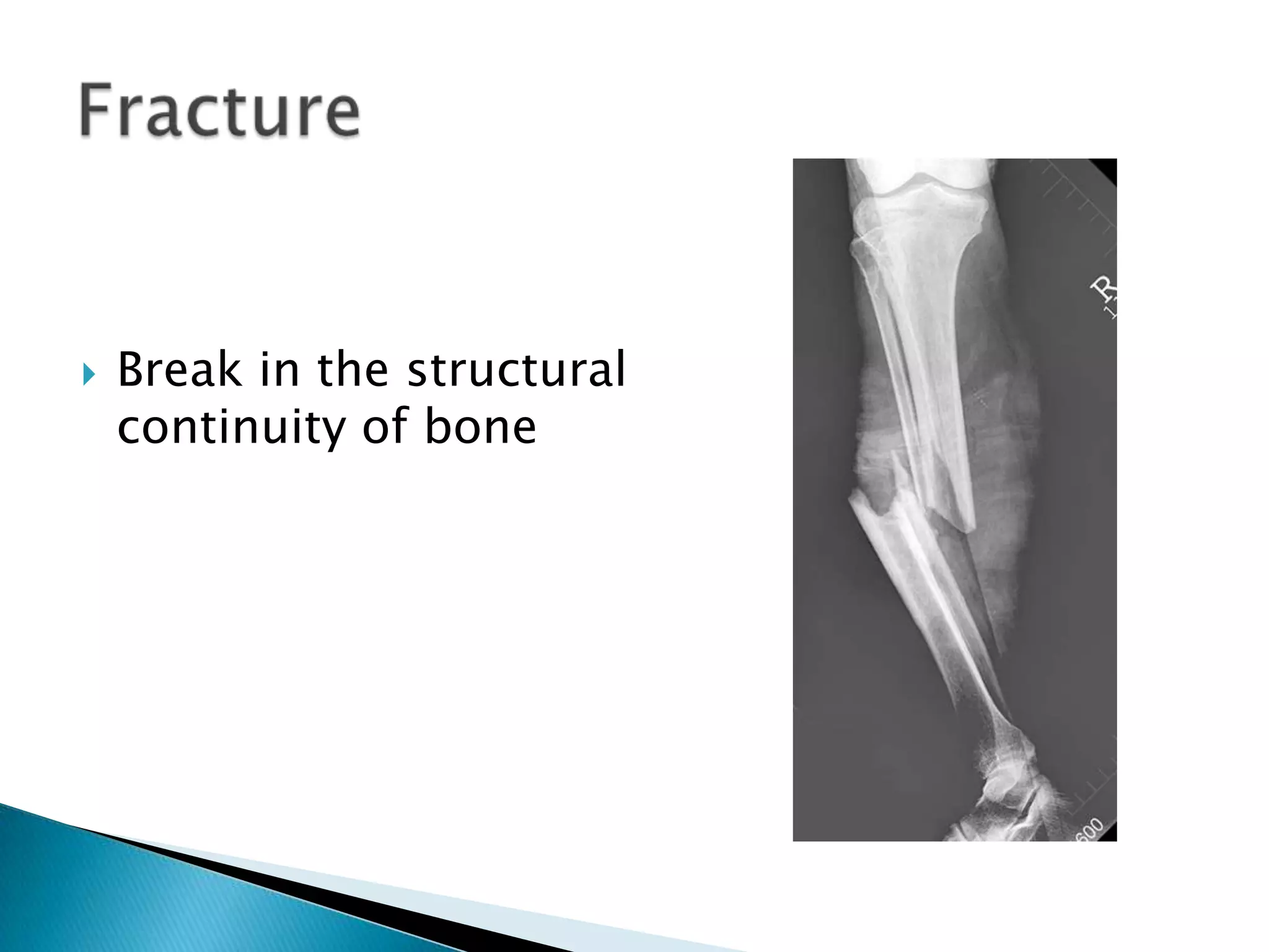

Break in the structural
continuity of bone

 