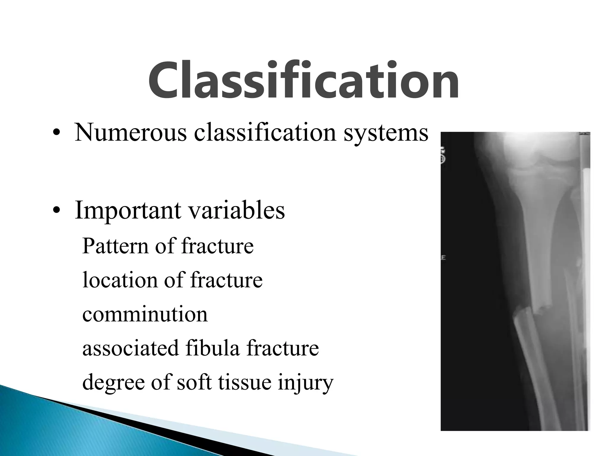 Classification
• Numerous classification systems
• Important variables
Pattern of fracture
location of fracture
comminution
associated fibula fracture
degree of soft tissue injury

 