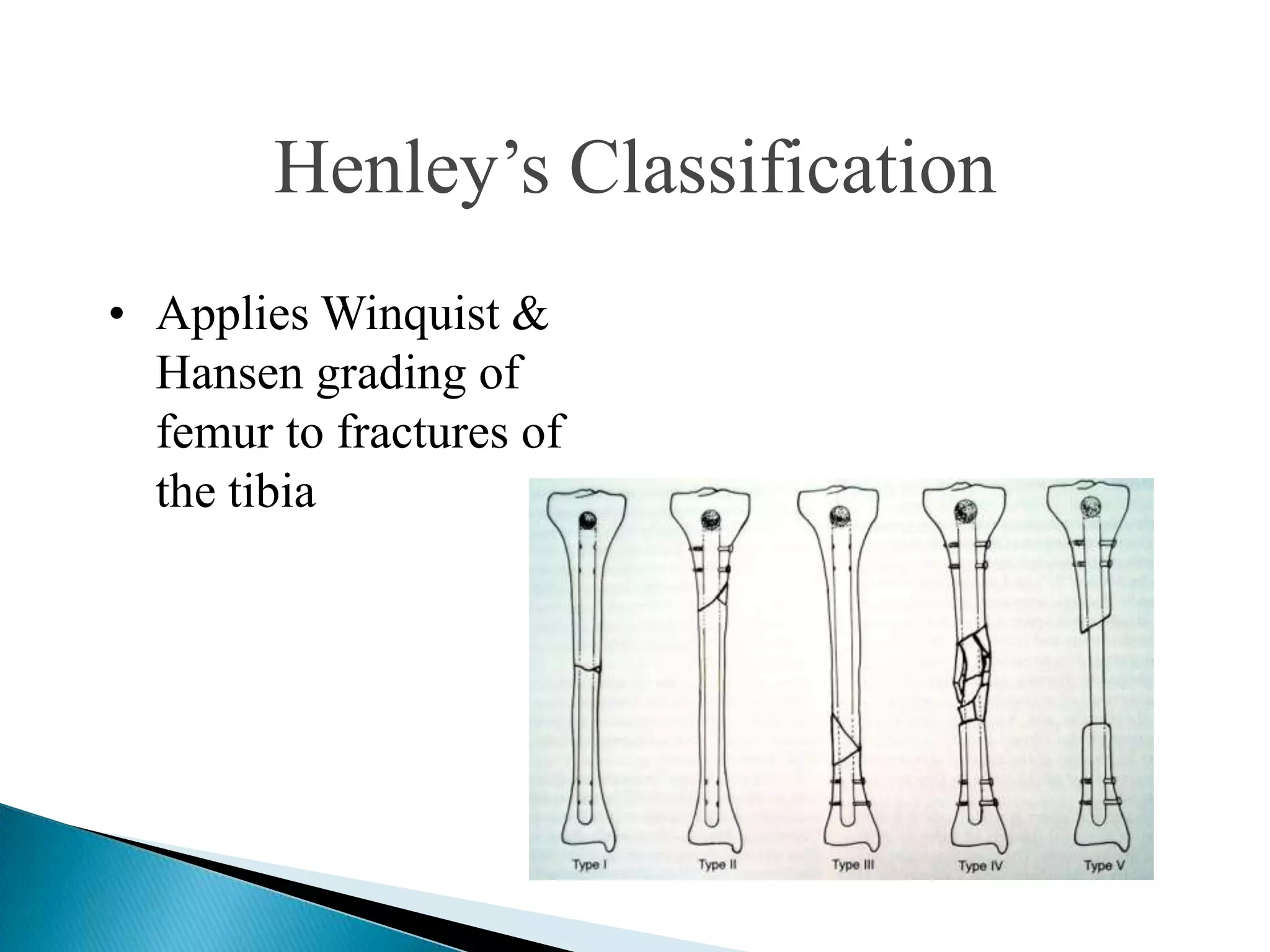 Henley‟s Classification
• Applies Winquist &
Hansen grading of
femur to fractures of
the tibia

 