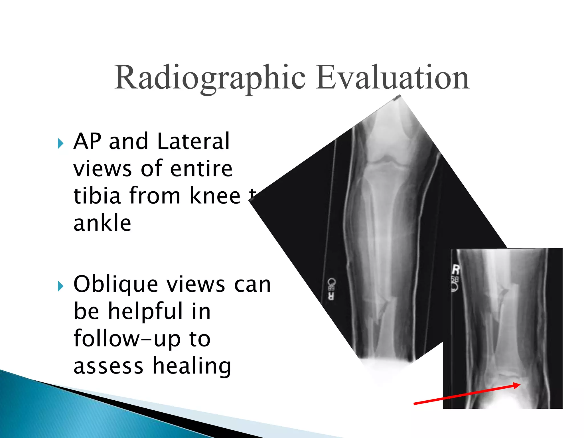 Radiographic Evaluation




AP and Lateral
views of entire
tibia from knee to
ankle
Oblique views can
be helpful in
follow-up to
assess healing

 