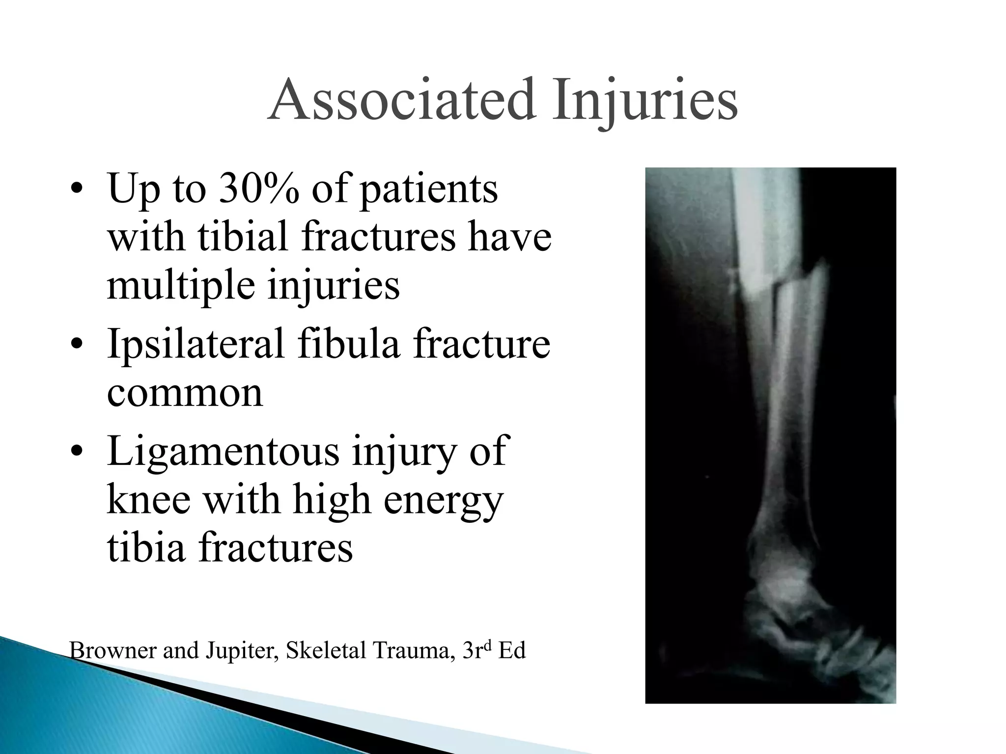 Associated Injuries
• Up to 30% of patients
with tibial fractures have
multiple injuries
• Ipsilateral fibula fracture
common
• Ligamentous injury of
knee with high energy
tibia fractures
Browner and Jupiter, Skeletal Trauma, 3rd Ed

 