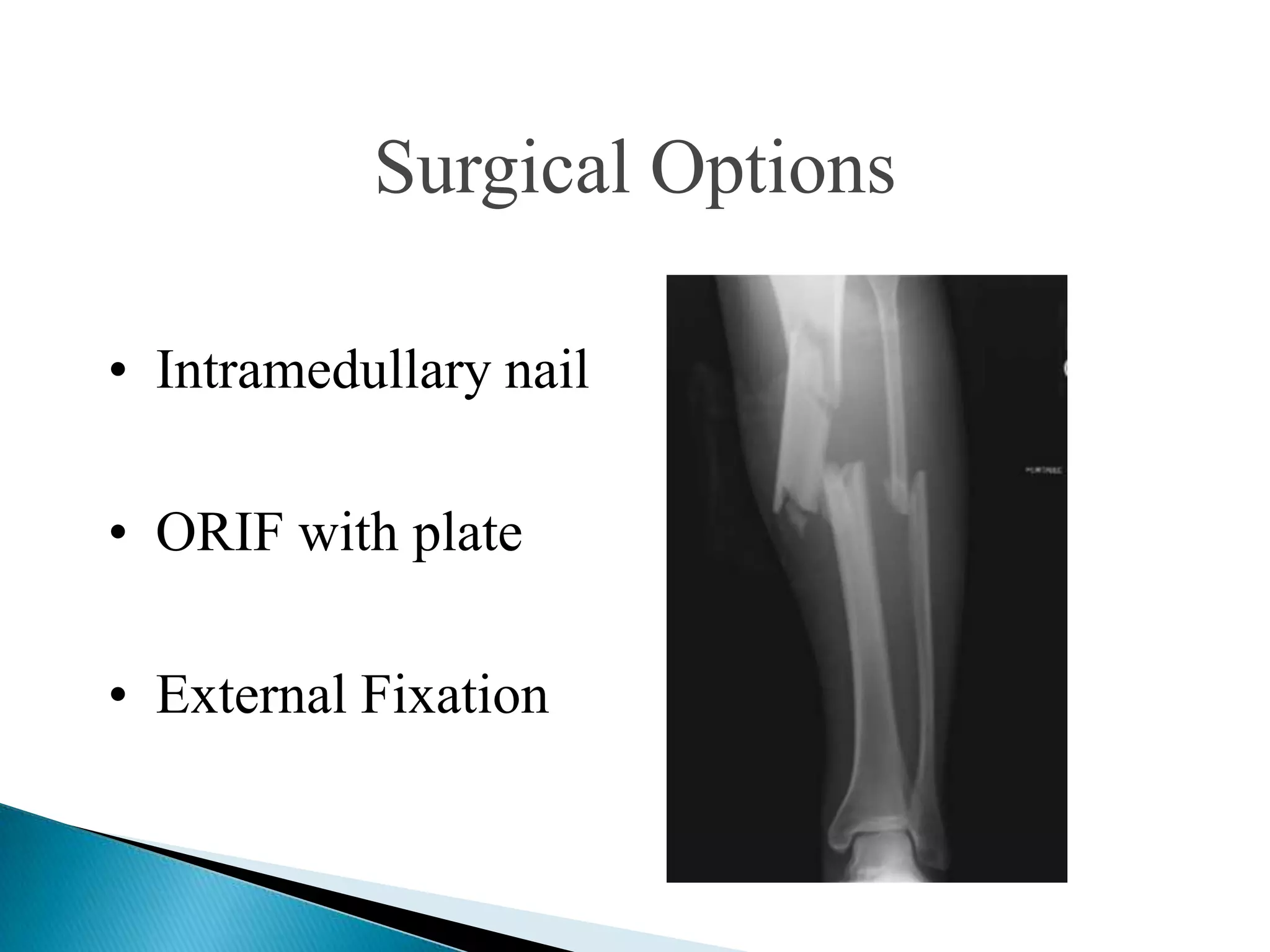 Surgical Options
• Intramedullary nail

• ORIF with plate
• External Fixation

 