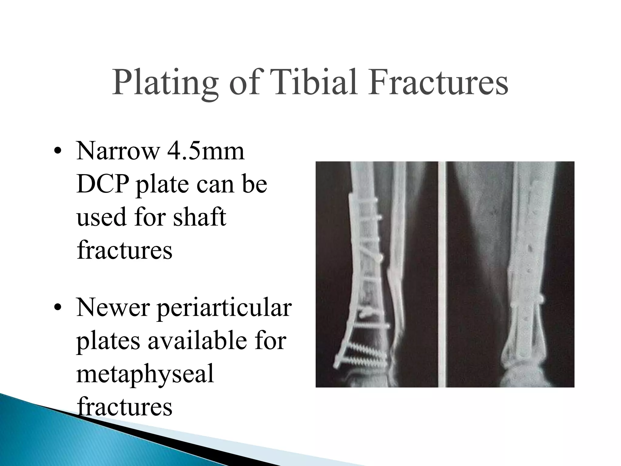 Plating of Tibial Fractures
• Narrow 4.5mm
DCP plate can be
used for shaft
fractures
• Newer periarticular
plates available for
metaphyseal
fractures

 