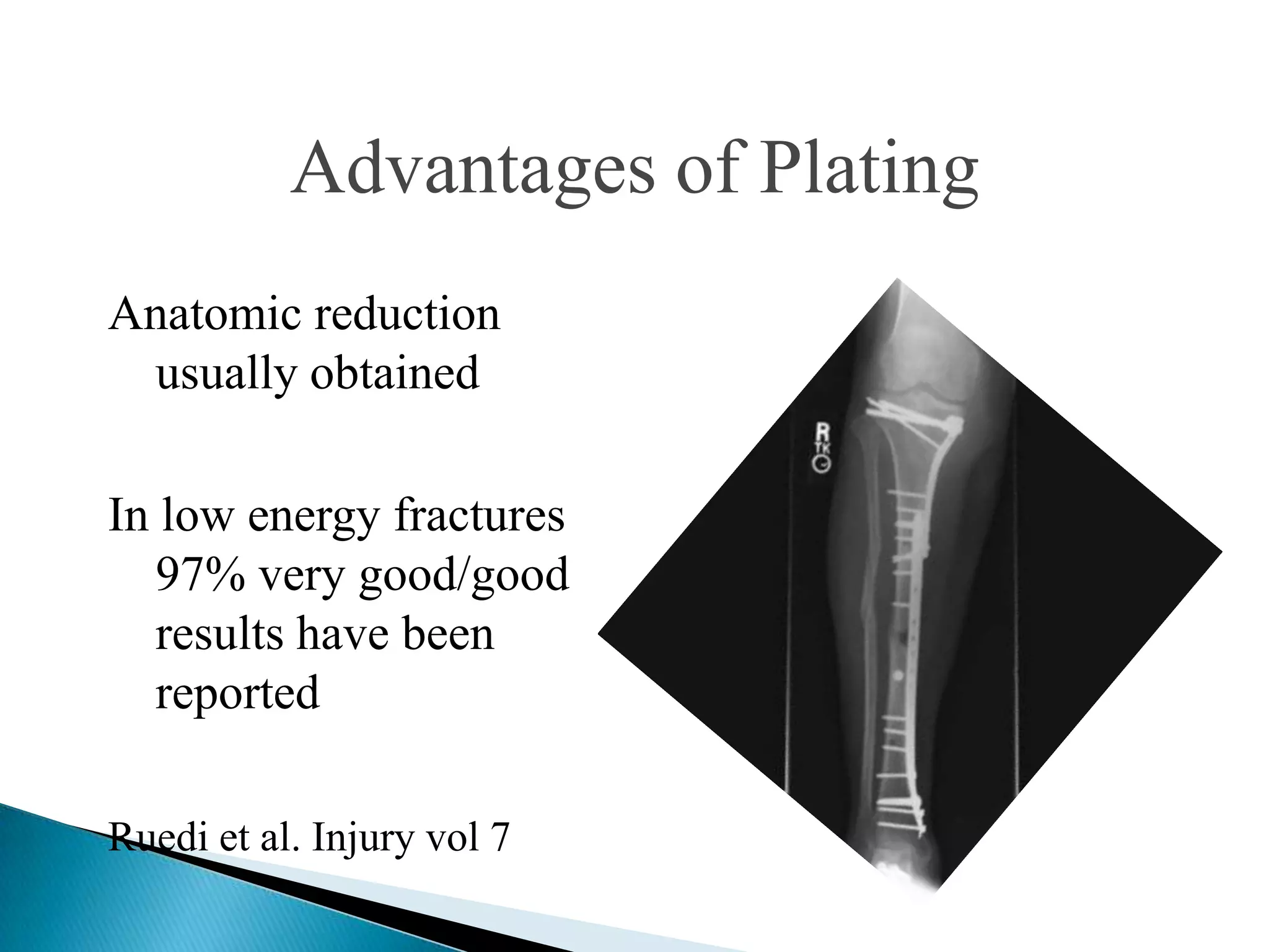 Advantages of Plating
Anatomic reduction
usually obtained
In low energy fractures
97% very good/good
results have been
reported
Ruedi et al. Injury vol 7

 