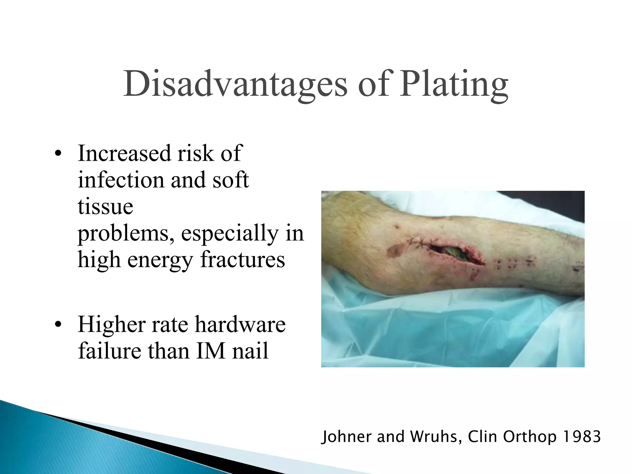 Disadvantages of Plating
• Increased risk of
infection and soft
tissue
problems, especially in
high energy fractures
• Higher rate hardware
failure than IM nail
Johner and Wruhs, Clin Orthop 1983

 