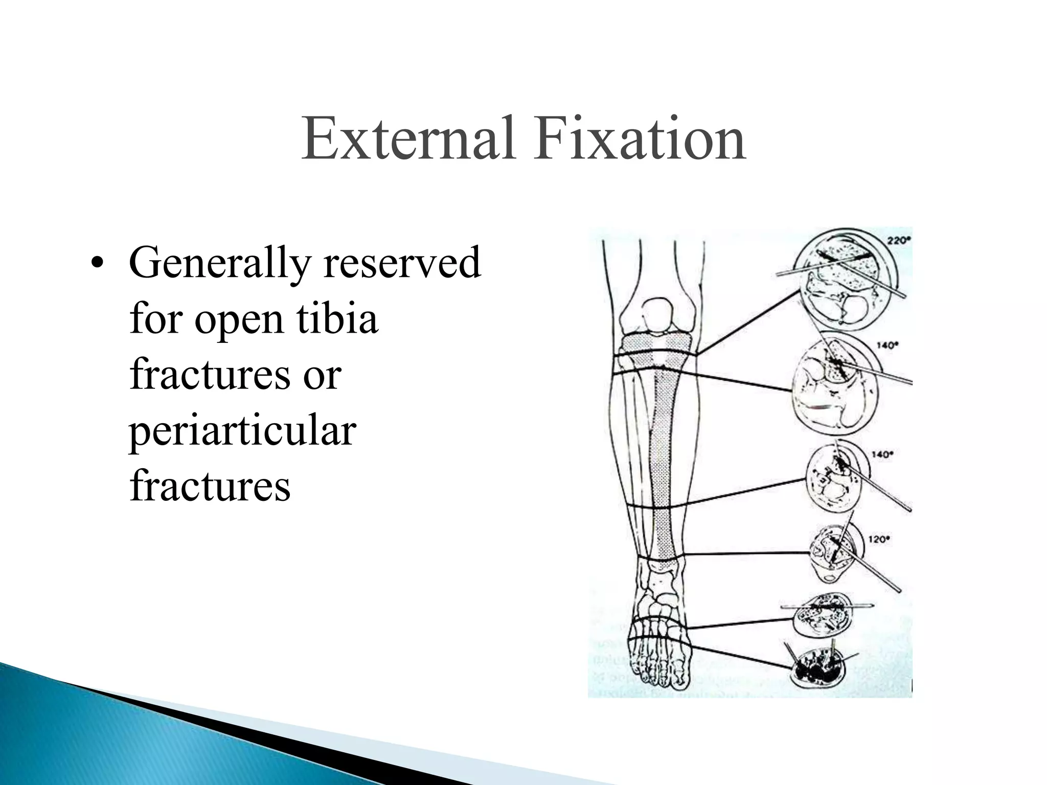 External Fixation
• Generally reserved
for open tibia
fractures or
periarticular
fractures

 